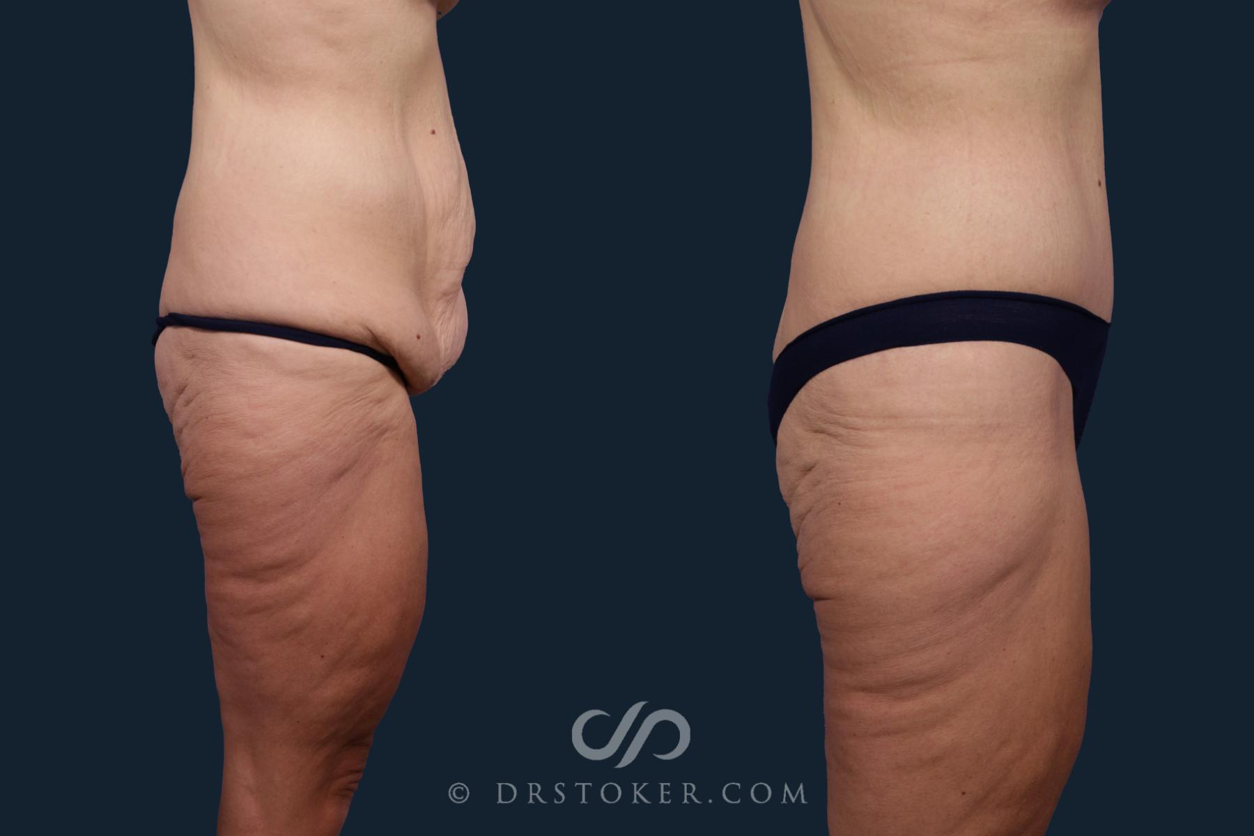 Before & After Tummy Tuck Case 2093 Right Side View in Los Angeles, CA