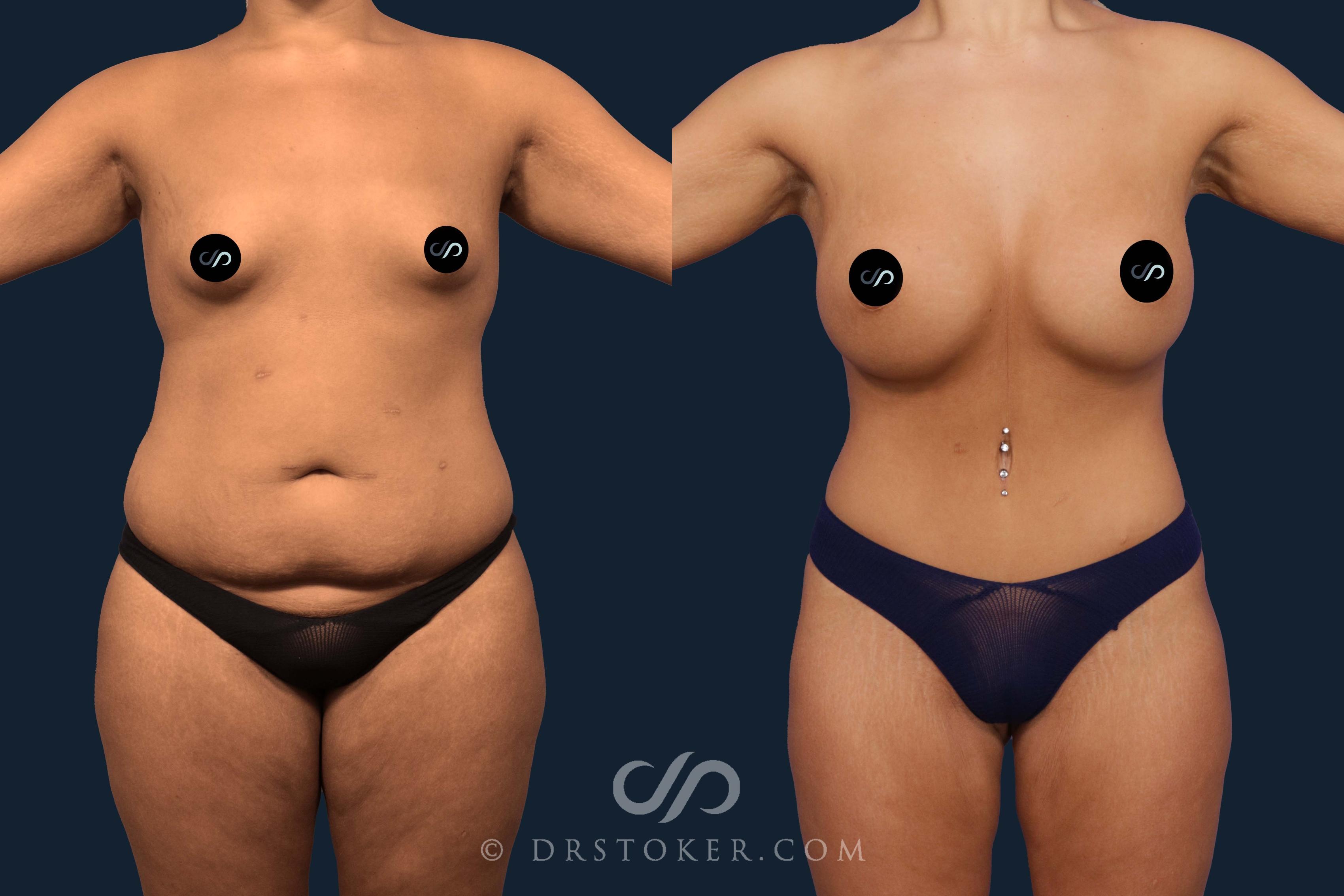 Before & After Tummy Tuck Case 2106 Front View in Los Angeles, CA