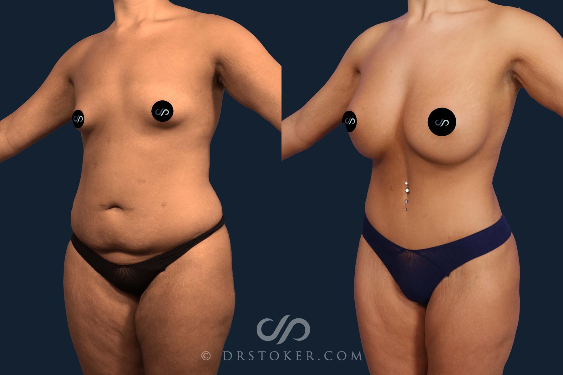 Before & After Tummy Tuck Case 2106 Left Oblique View in Los Angeles, CA