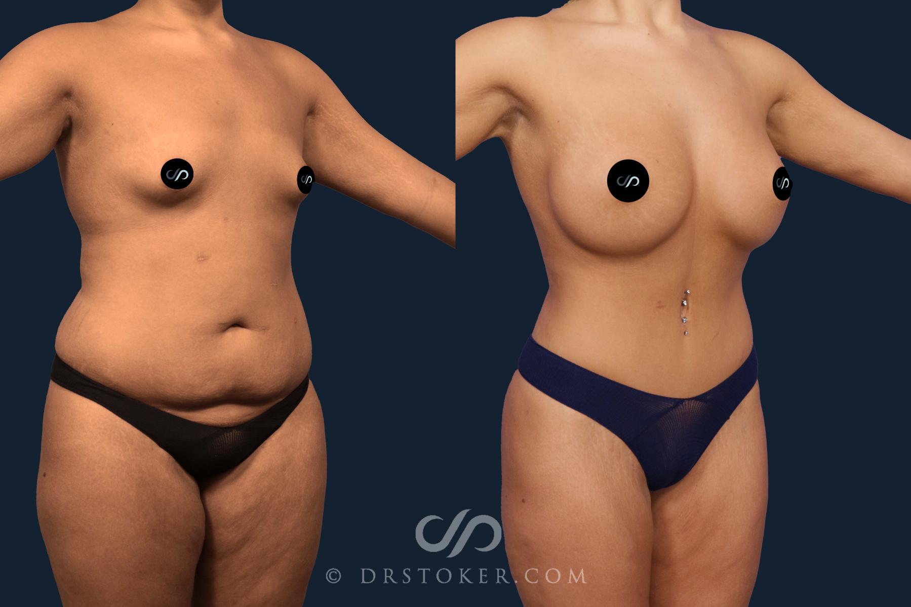 Before & After Tummy Tuck Case 2106 Right Oblique View in Los Angeles, CA