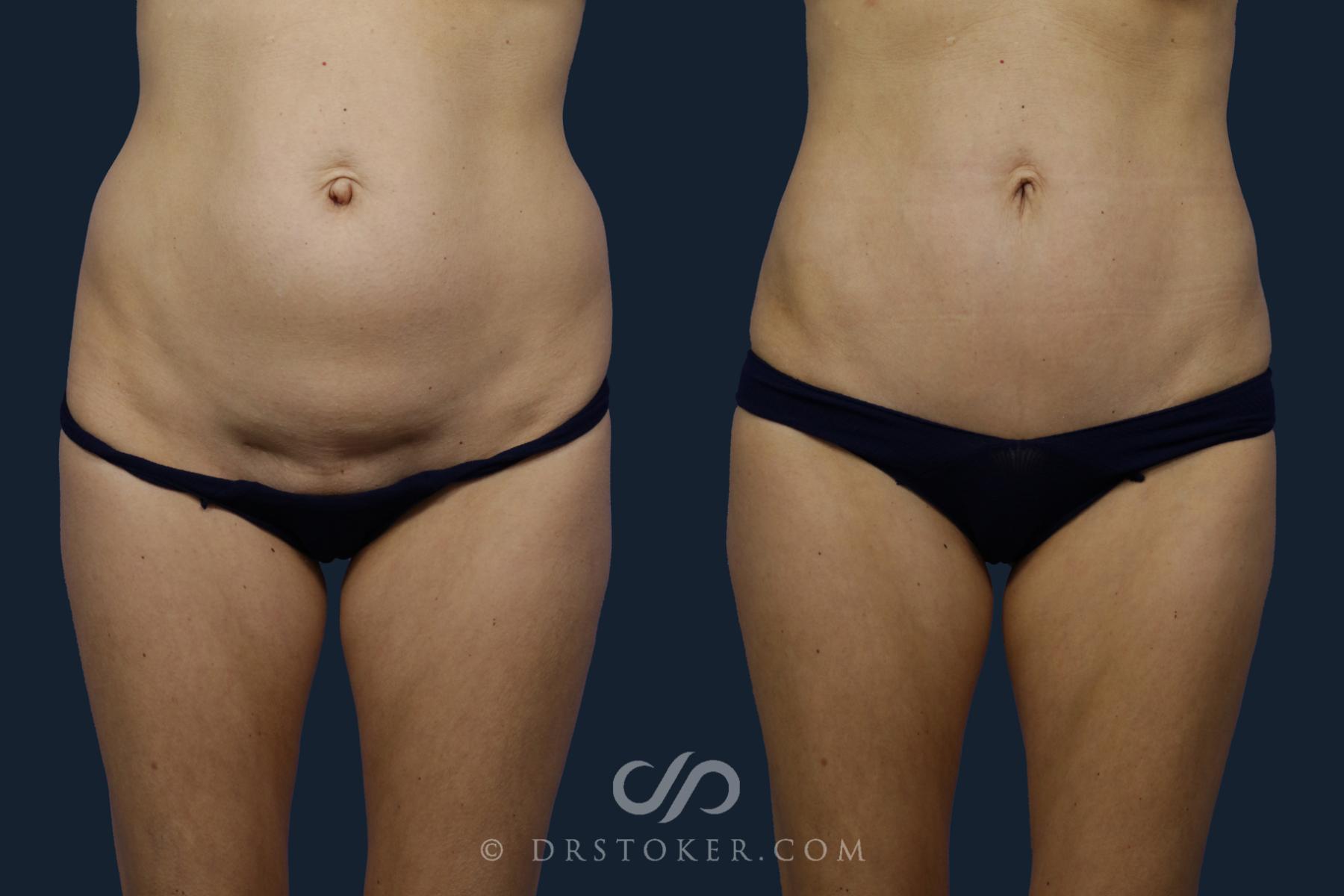 Before & After Tummy Tuck Case 2130 Front View in Los Angeles, CA