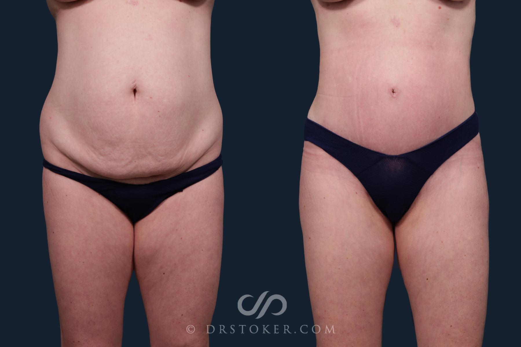 Before & After Liposuction Case 2131 Front View in Los Angeles, CA