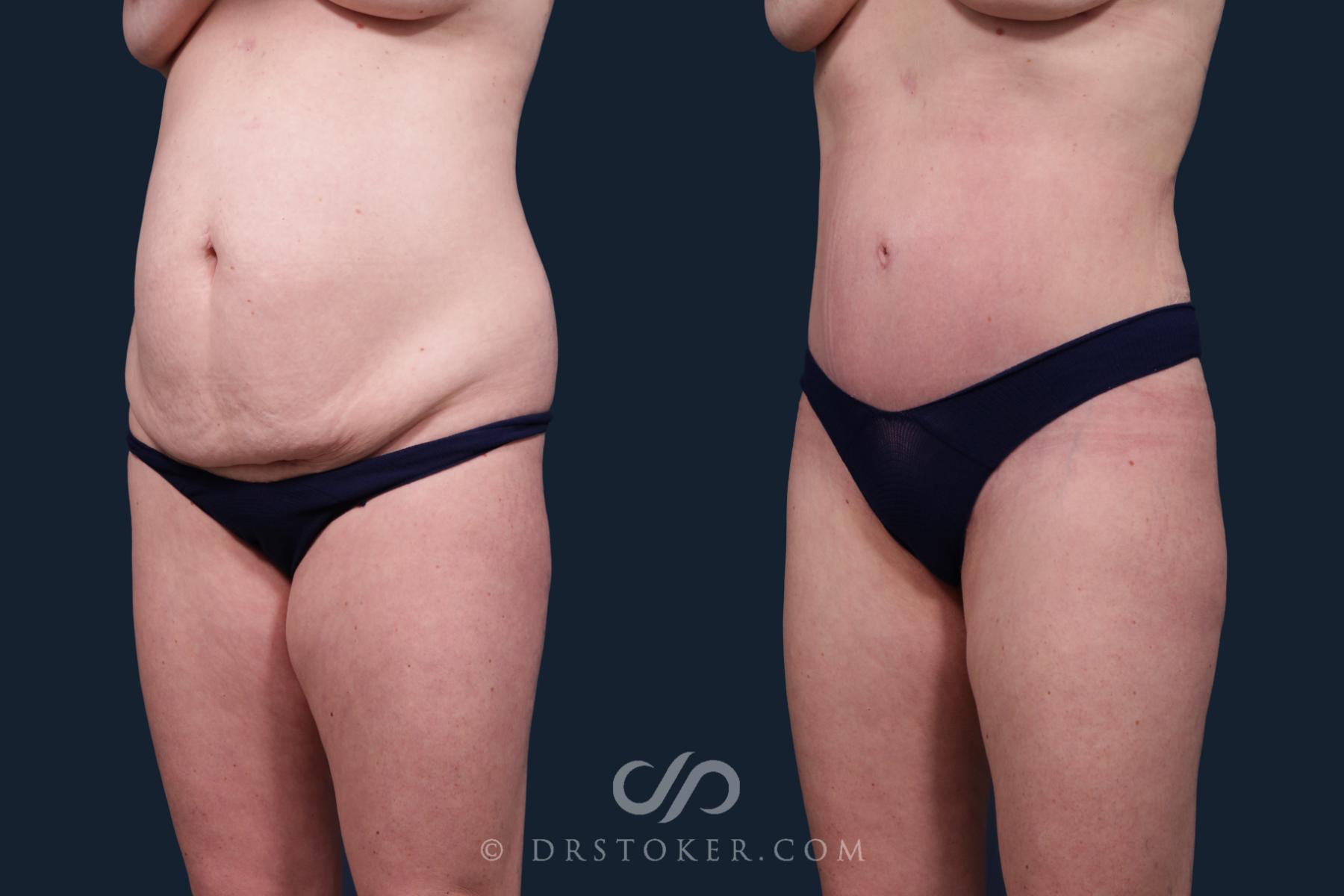 Before & After Tummy Tuck Case 2131 Left Oblique View in Los Angeles, CA