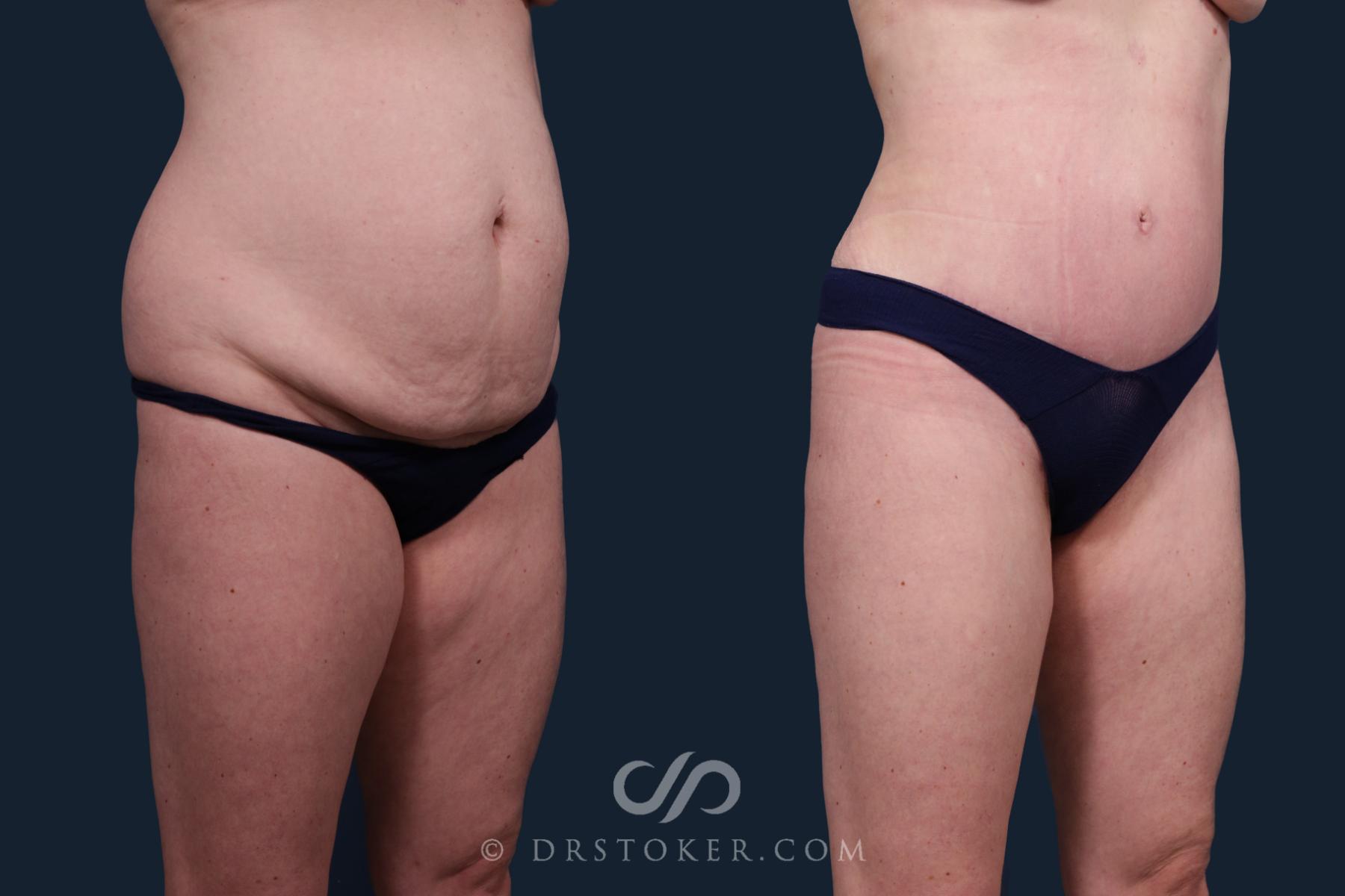 Before & After Tummy Tuck Case 2131 Right Oblique View in Los Angeles, CA