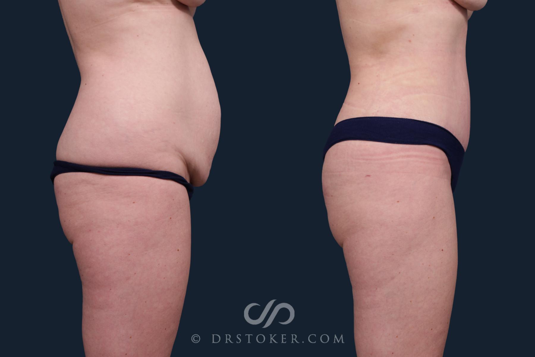 Before & After Tummy Tuck Case 2131 Right Side View in Los Angeles, CA