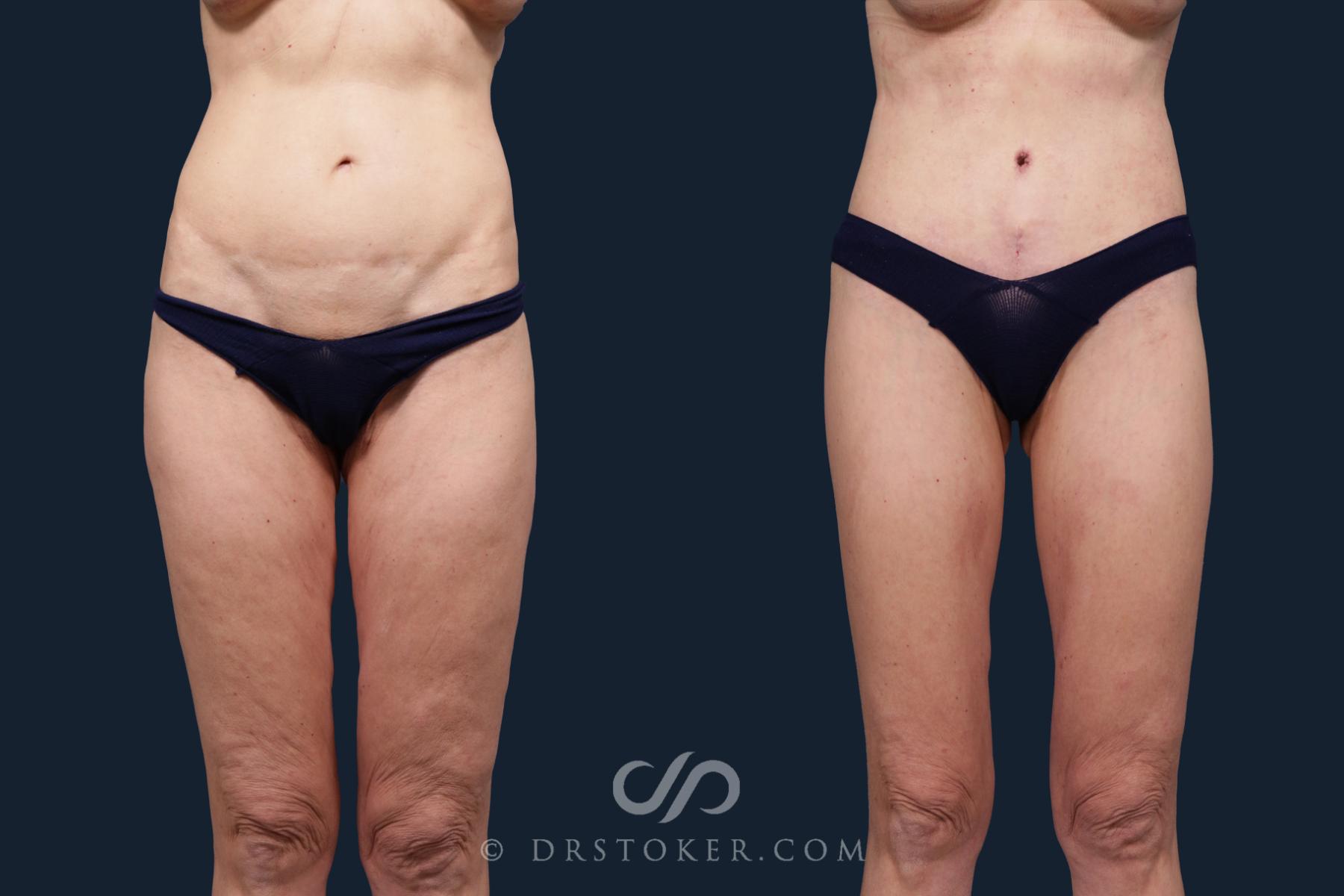 Before & After Tummy Tuck Case 2133 Front View in Los Angeles, CA