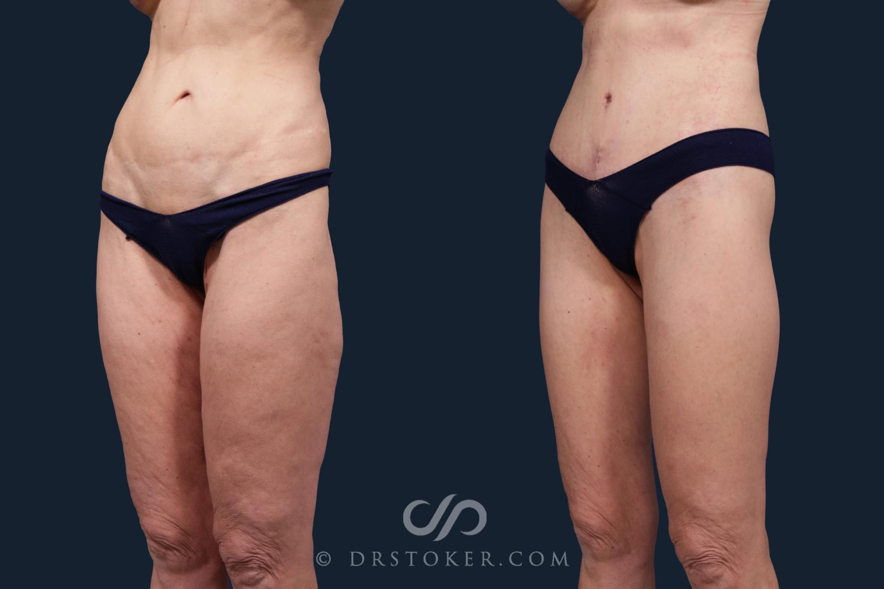 Before & After Tummy Tuck Case 2133 Left Oblique View in Los Angeles, CA