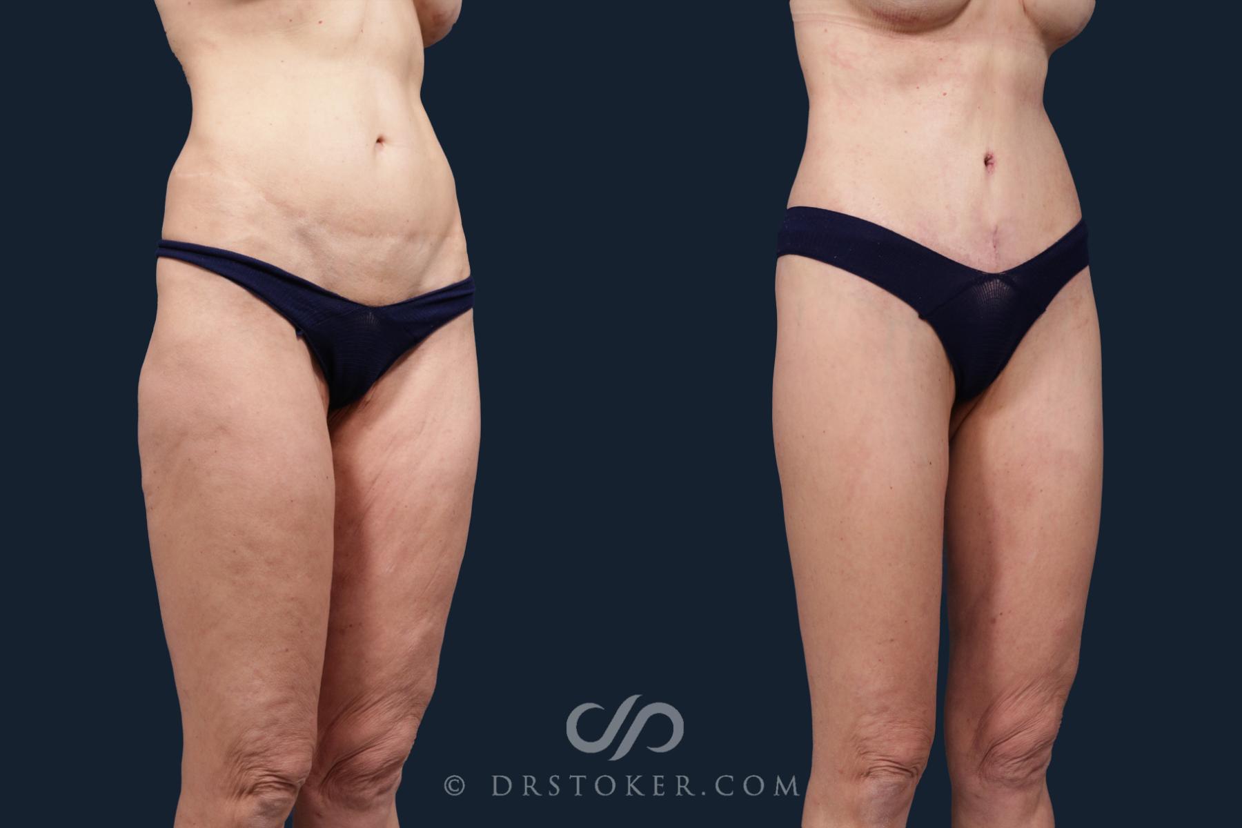 Before & After Tummy Tuck Case 2133 Right Oblique View in Los Angeles, CA