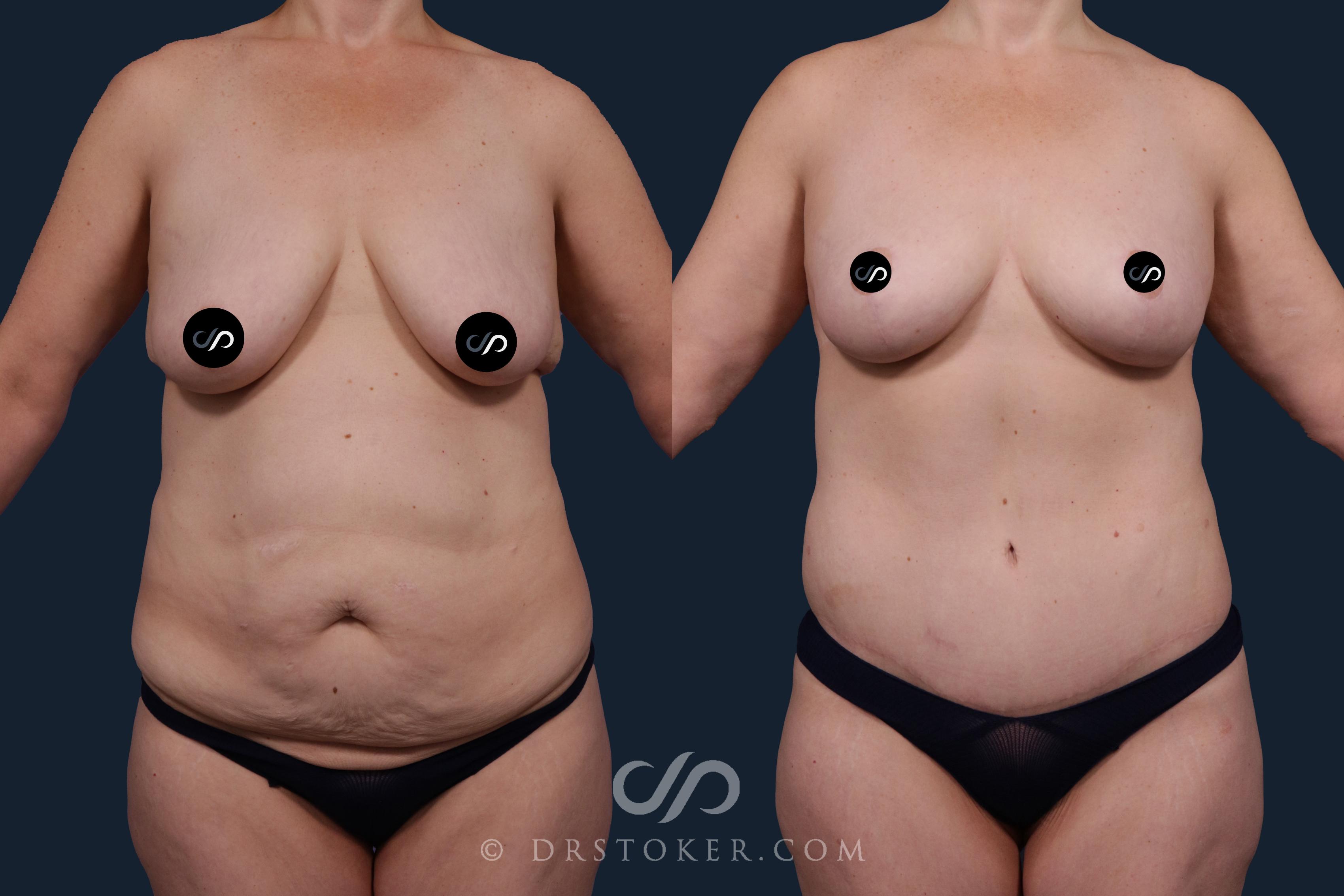 Before & After Tummy Tuck Case 2150 Front View in Los Angeles, CA