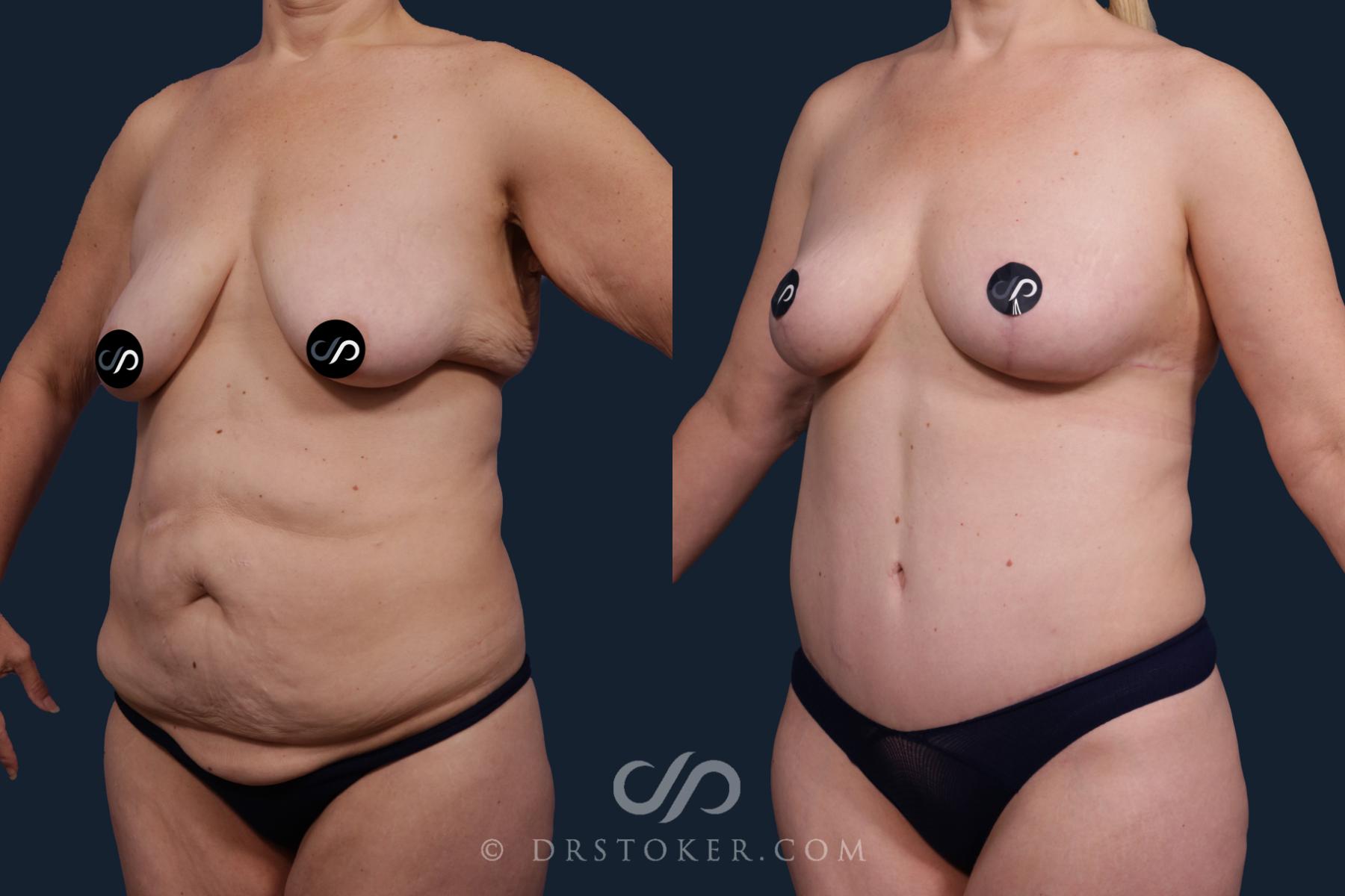 Before & After Tummy Tuck Case 2150 Left Oblique View in Los Angeles, CA