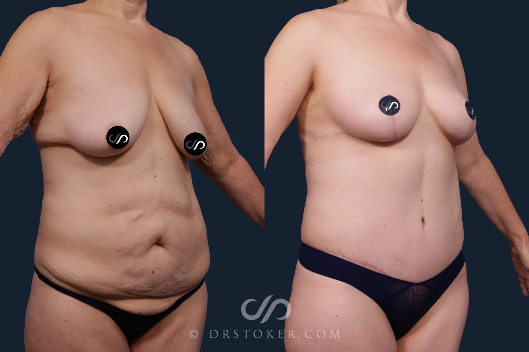 Before & After Tummy Tuck Case 2150 Right Oblique View in Los Angeles, CA