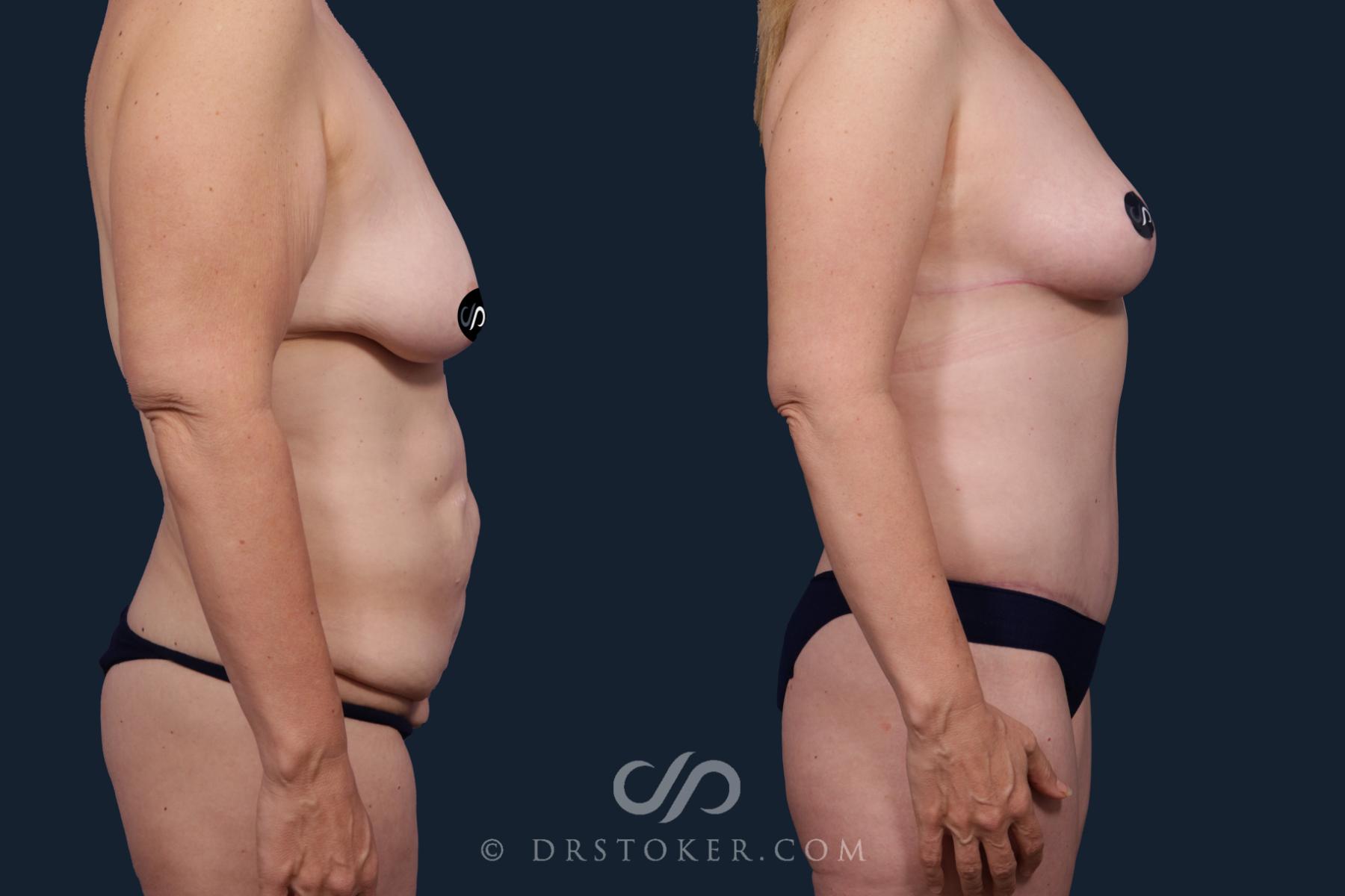 Before & After Tummy Tuck Case 2150 Right Side View in Los Angeles, CA