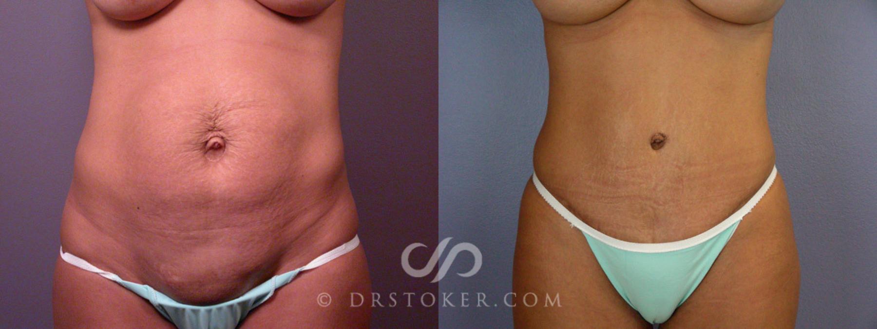 Before & After Tummy Tuck Case 235 View #11 View in Los Angeles, CA