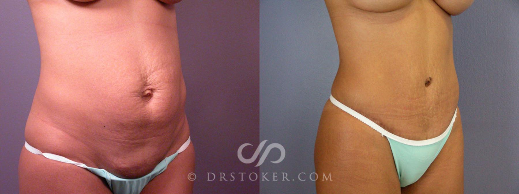 Before & After Tummy Tuck Case 235 View #12 View in Los Angeles, CA