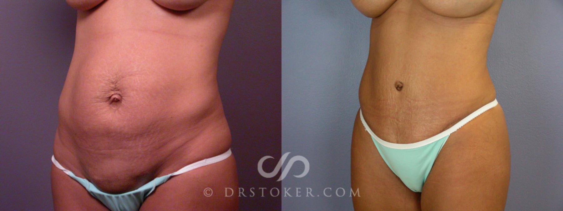 Before & After Tummy Tuck Case 235 View #13 View in Los Angeles, CA