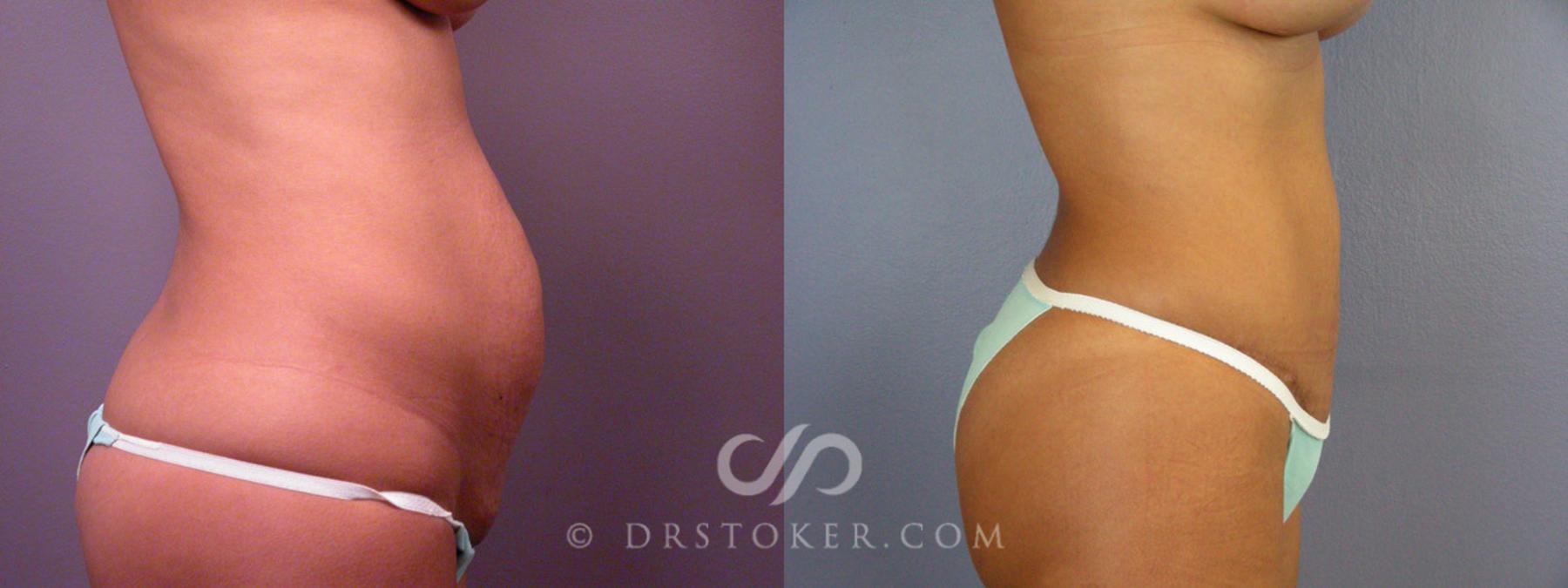 Before & After Tummy Tuck Case 235 View #14 View in Los Angeles, CA