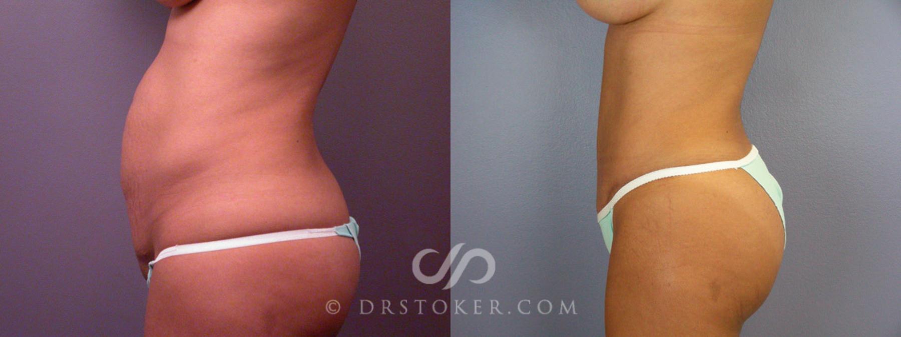 Before & After Tummy Tuck Case 235 View #15 View in Los Angeles, CA