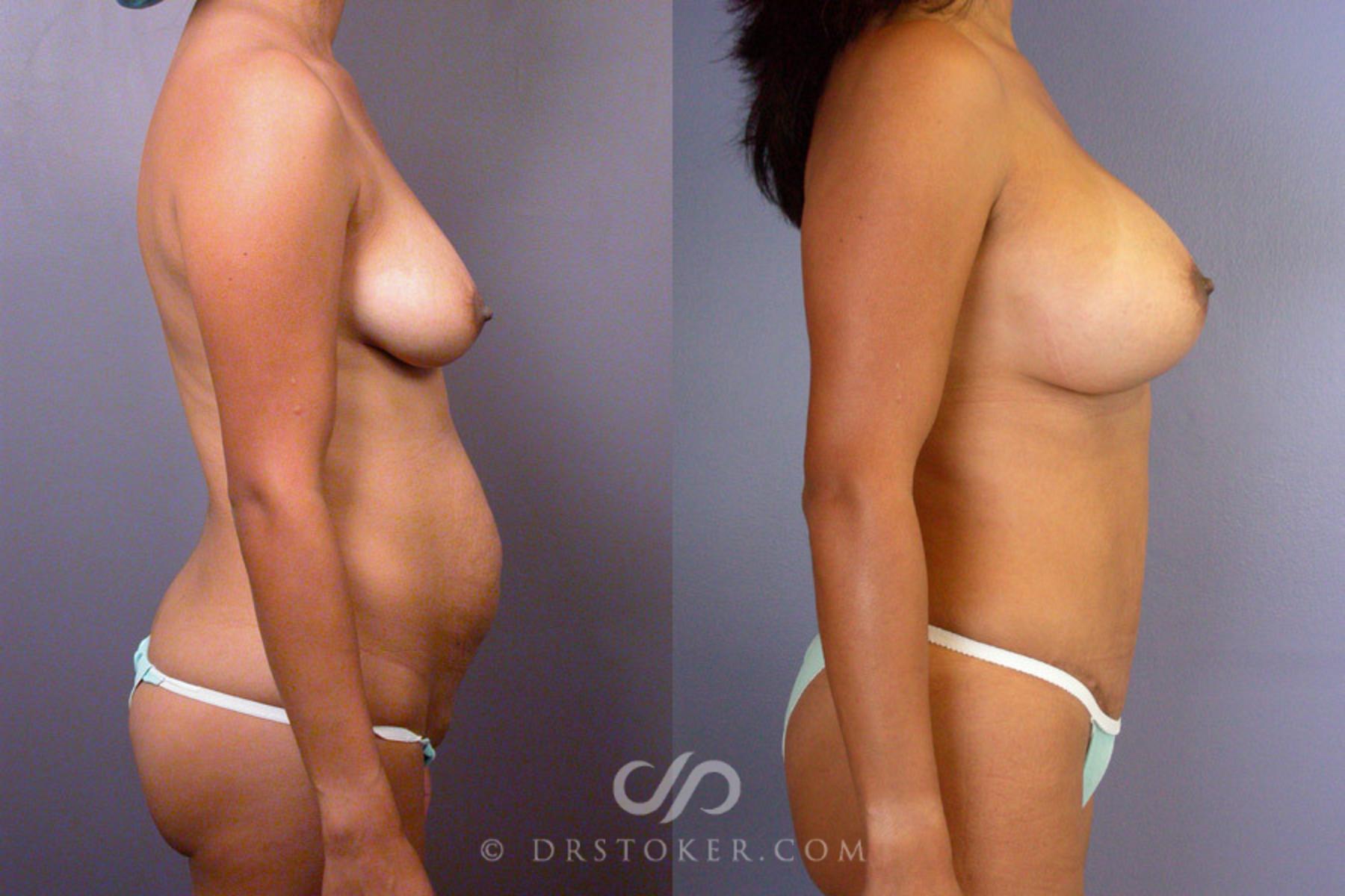 Before & After Tummy Tuck Case 235 View #4 View in Los Angeles, CA