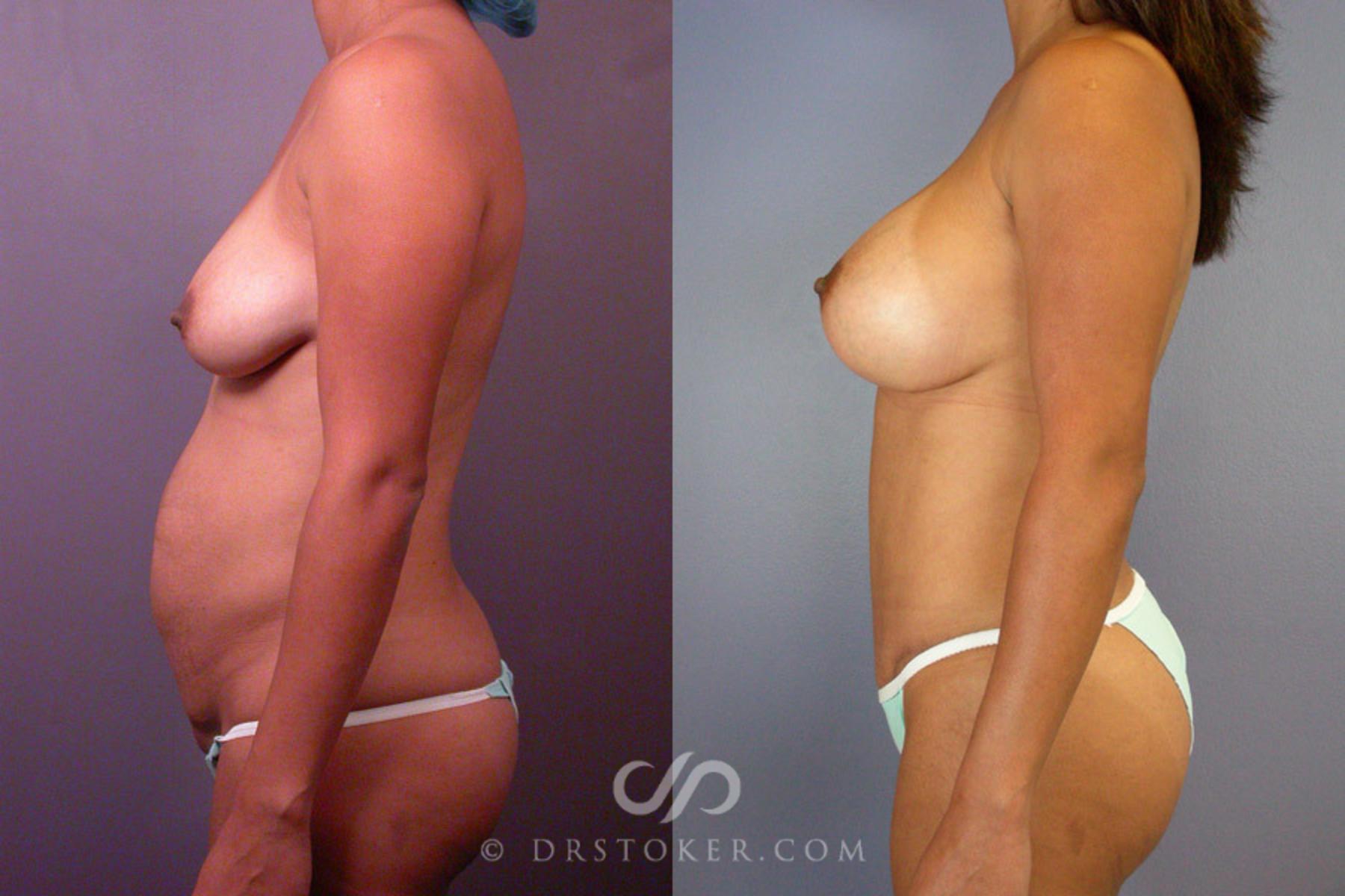 Before & After Tummy Tuck Case 235 View #5 View in Los Angeles, CA