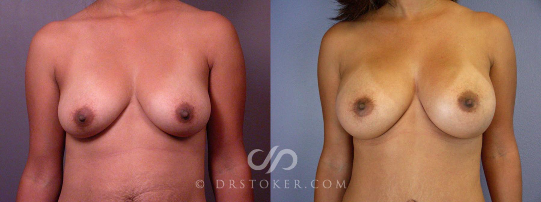 Before & After Tummy Tuck Case 235 View #6 View in Los Angeles, CA