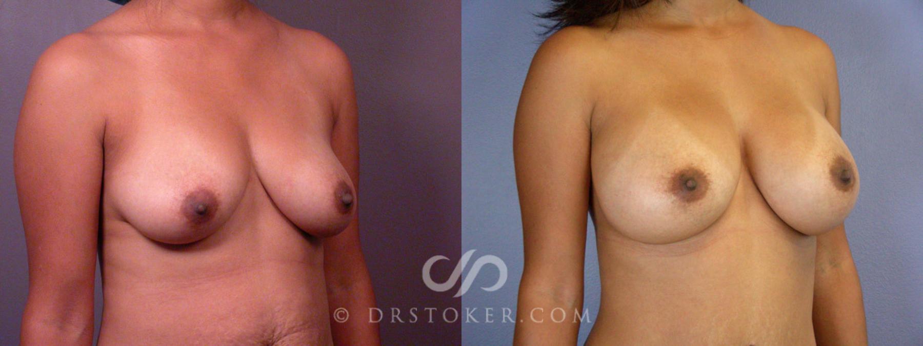 Before & After Tummy Tuck Case 235 View #7 View in Los Angeles, CA