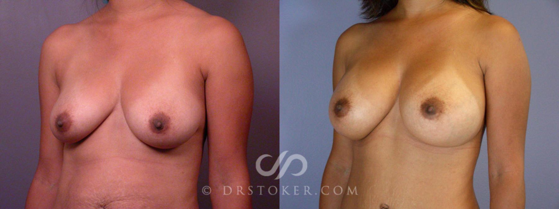 Before & After Tummy Tuck Case 235 View #8 View in Los Angeles, CA
