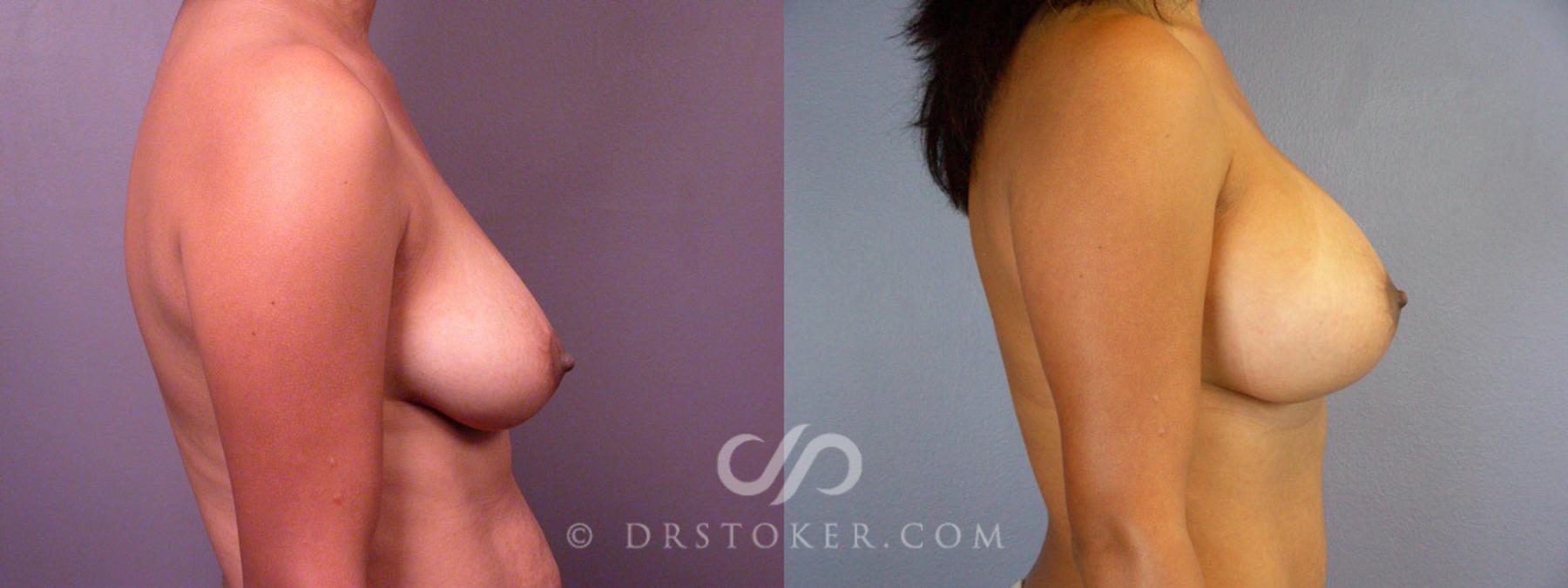 Before & After Tummy Tuck Case 235 View #9 View in Los Angeles, CA