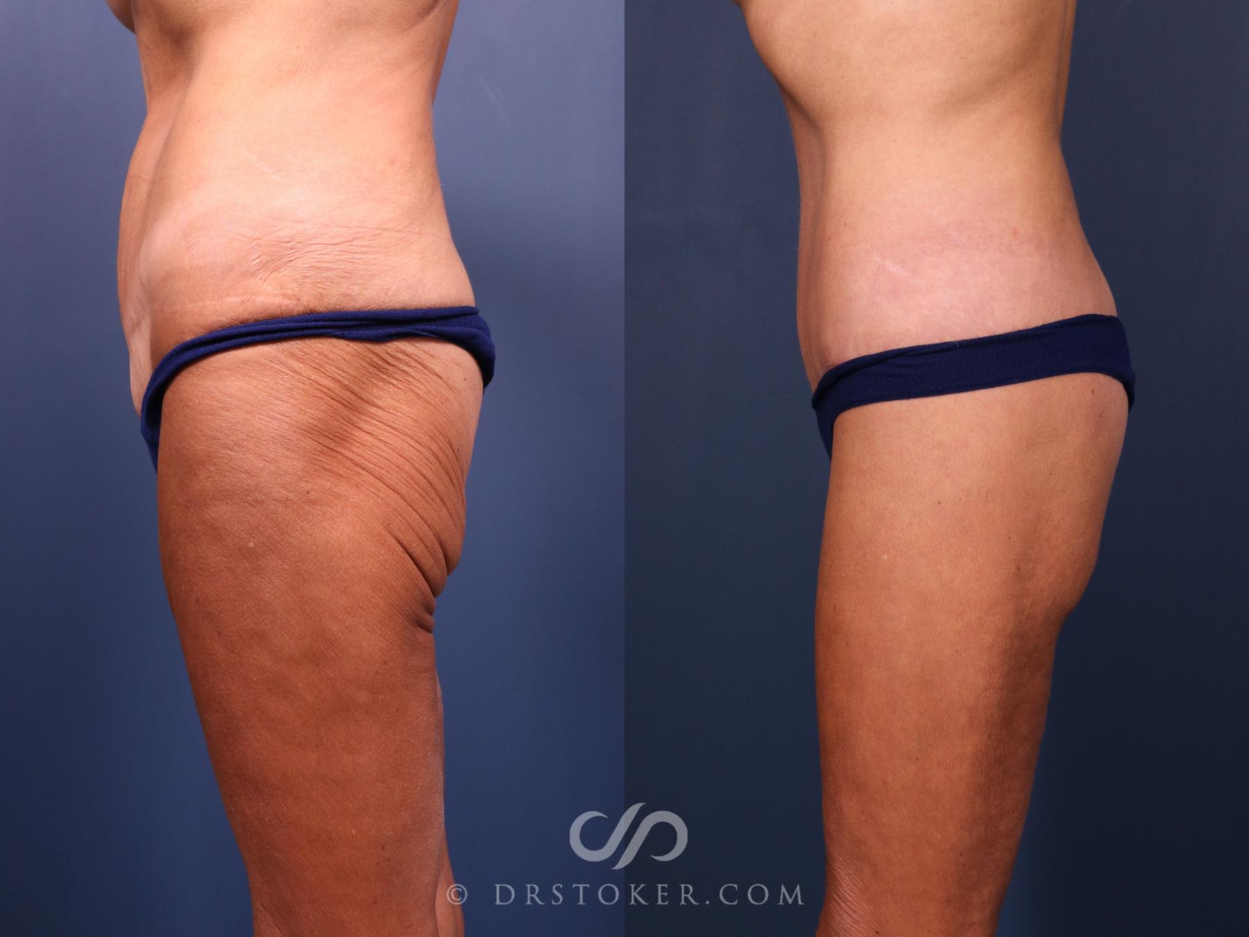 Before & After Tummy Tuck Case 2387 Left Oblique View in Los Angeles, CA