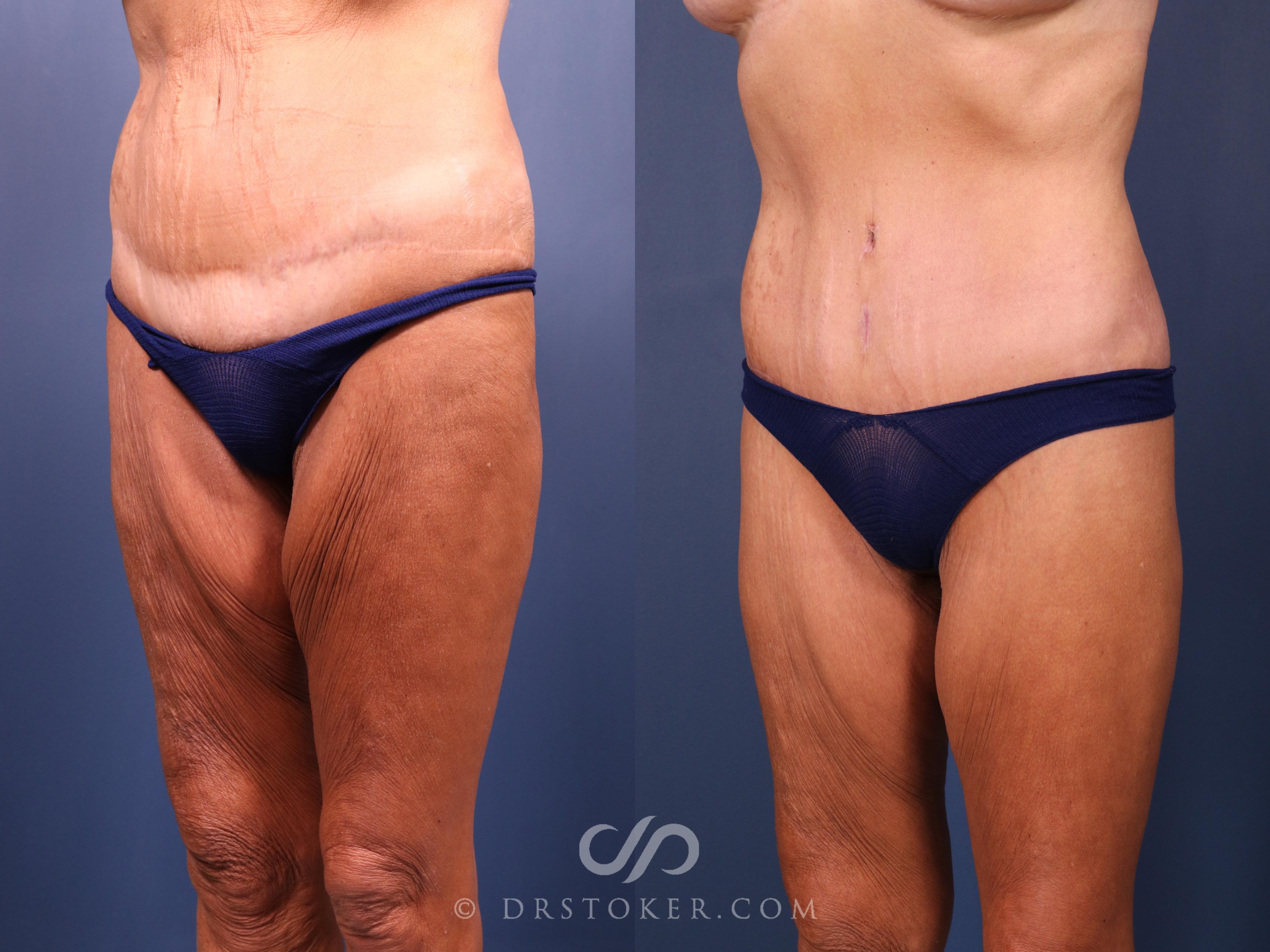 Before & After Tummy Tuck Case 2387 Left Side View in Los Angeles, CA