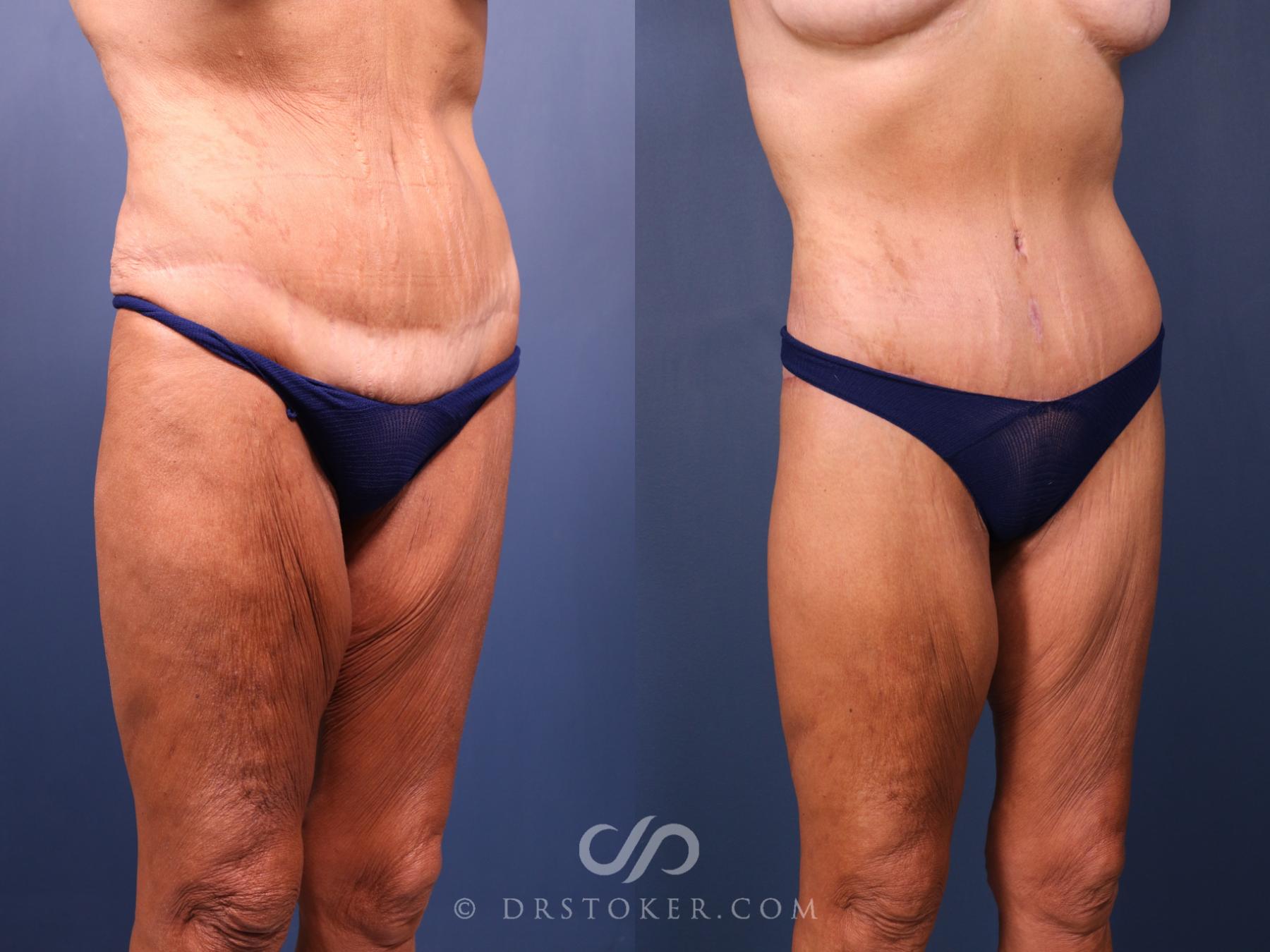 Before & After Tummy Tuck Case 2387 Right Oblique View in Los Angeles, CA