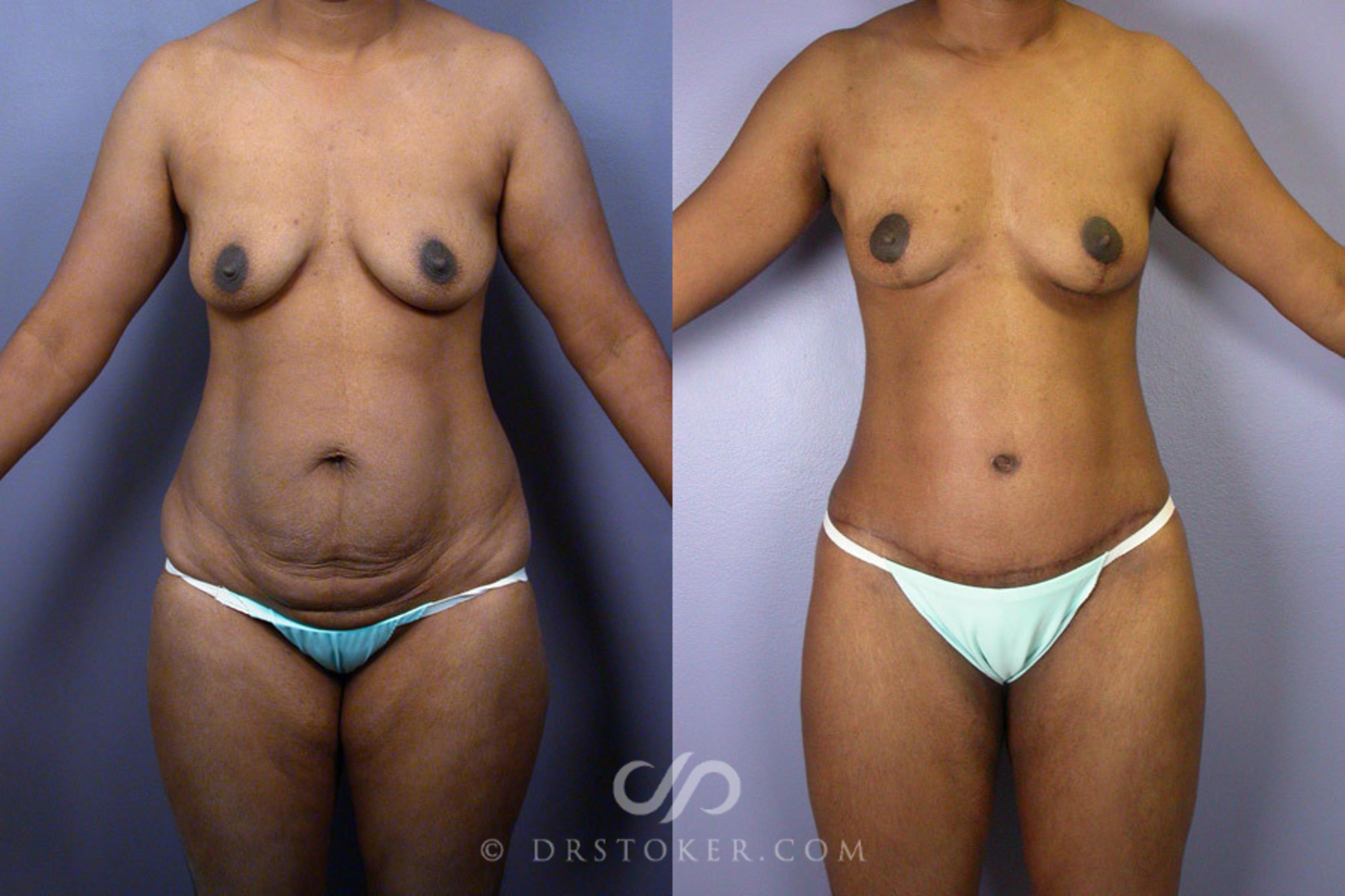 Before & After Tummy Tuck Case 239 View #1 View in Los Angeles, CA