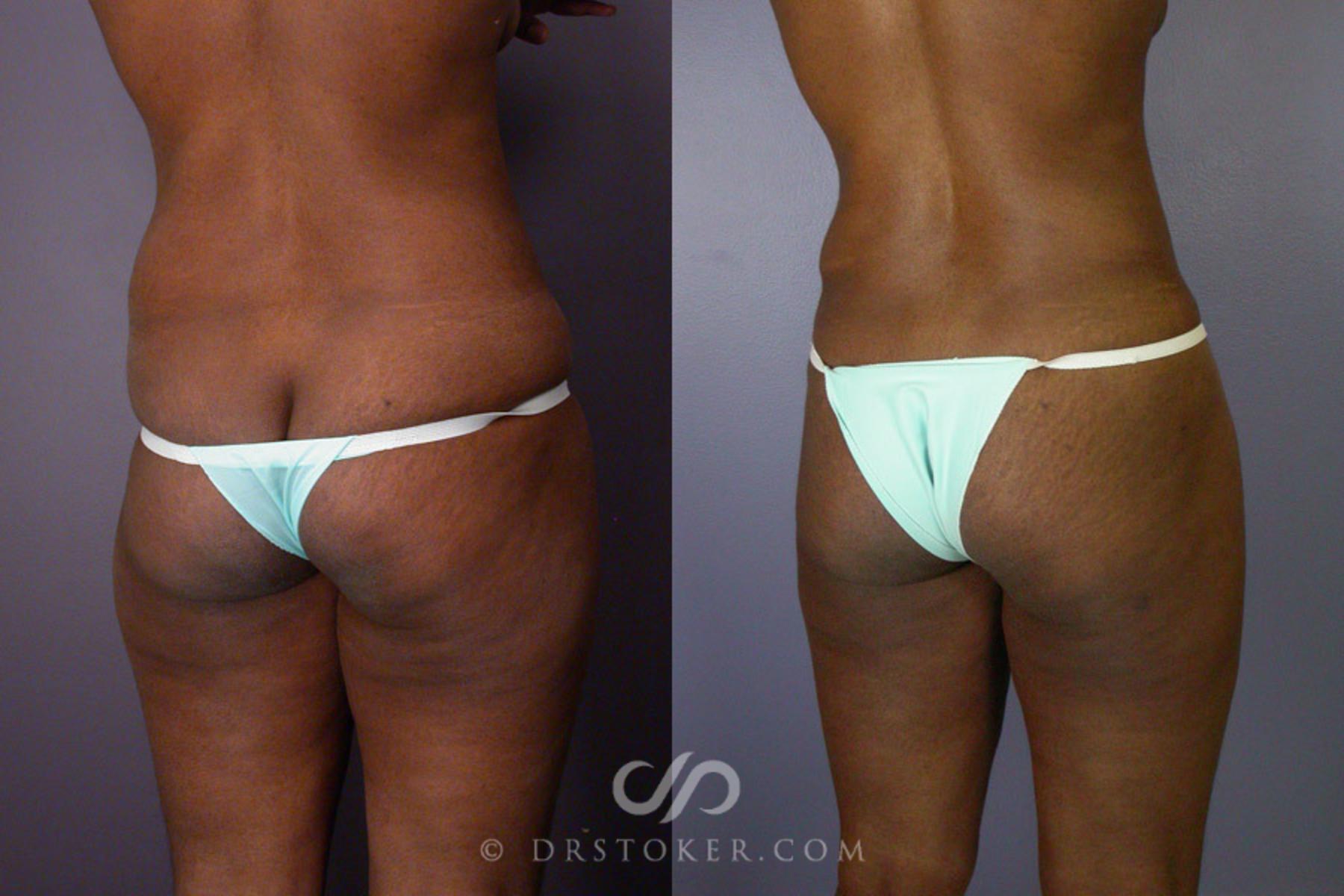 Before & After Tummy Tuck Case 239 View #10 View in Los Angeles, CA