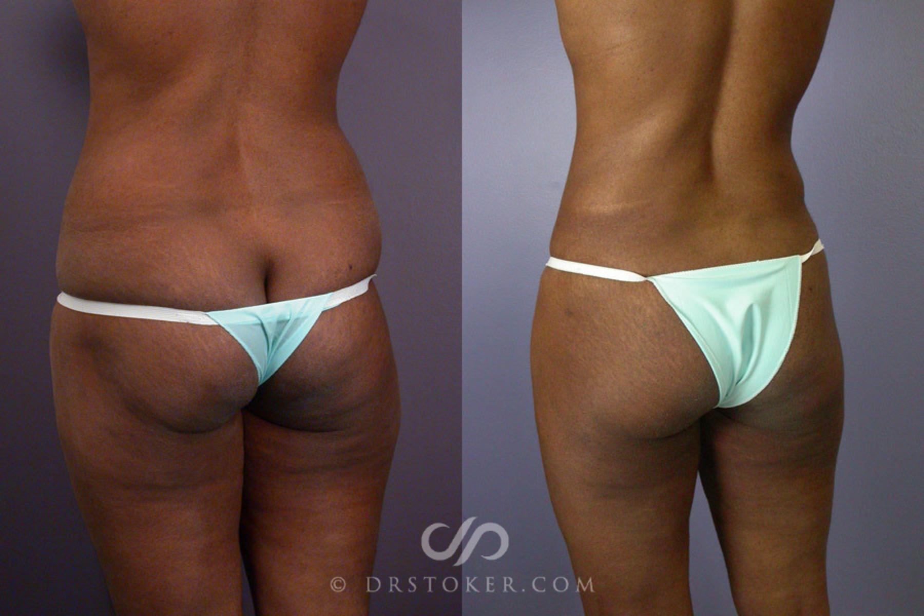 Before & After Tummy Tuck Case 239 View #11 View in Los Angeles, CA