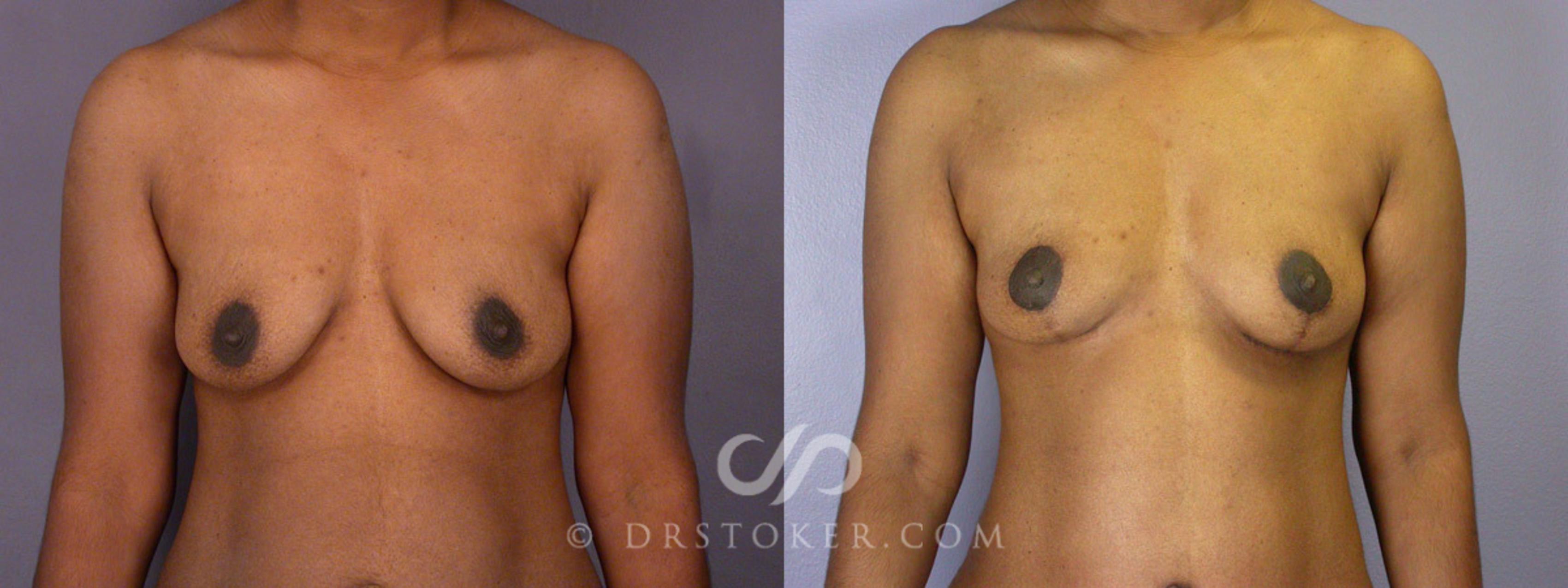 Before & After Tummy Tuck Case 239 View #12 View in Los Angeles, CA