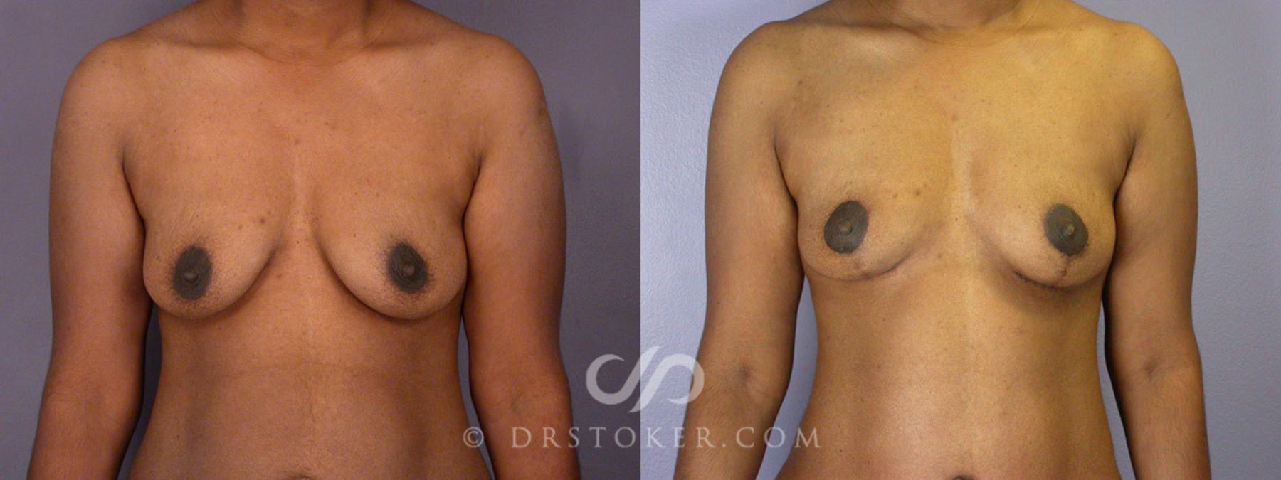 Before & After Breast Lift Case 239 View #12 View in Los Angeles, CA