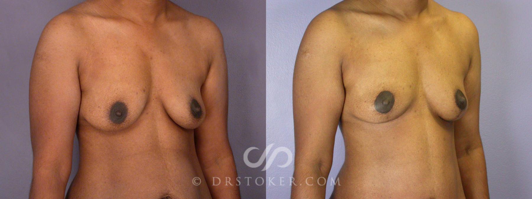 Before & After Breast Lift Case 239 View #13 View in Los Angeles, CA