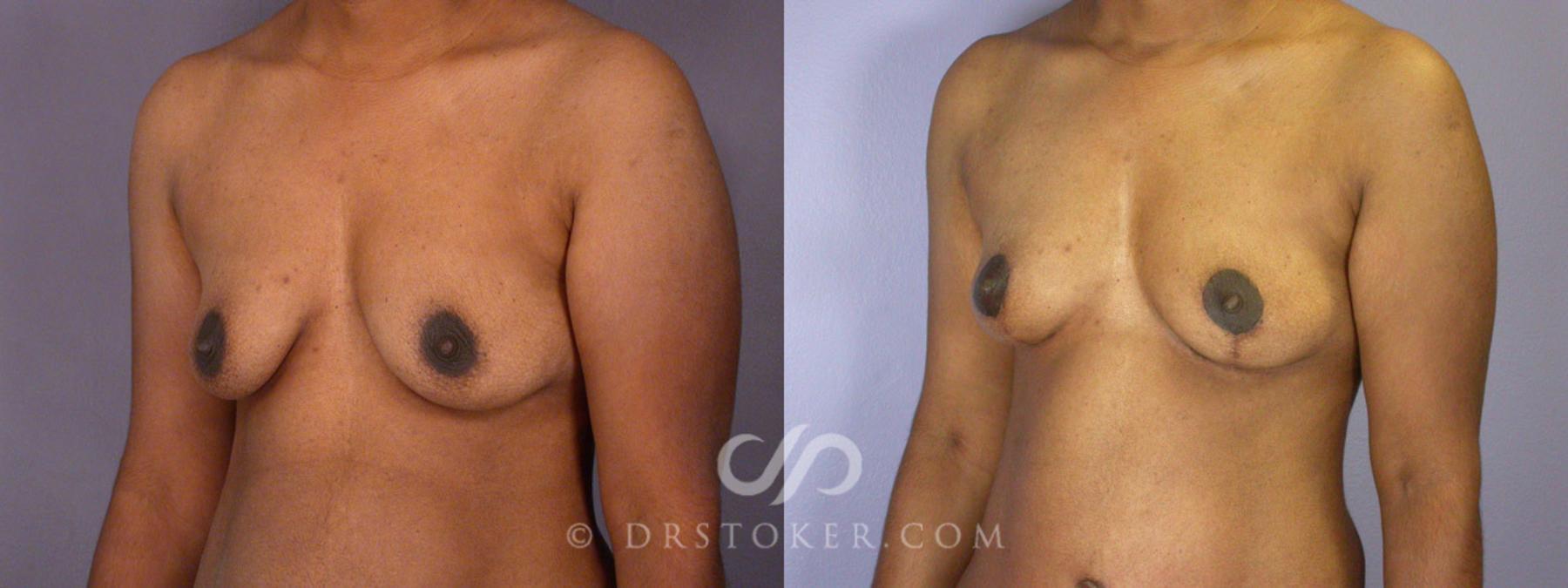 Before & After Tummy Tuck Case 239 View #14 View in Los Angeles, CA