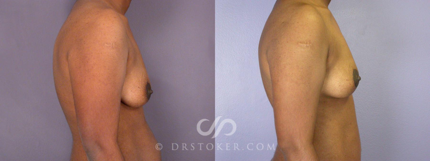 Before & After Tummy Tuck Case 239 View #15 View in Los Angeles, CA