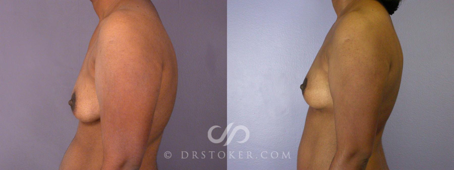Before & After Tummy Tuck Case 239 View #16 View in Los Angeles, CA