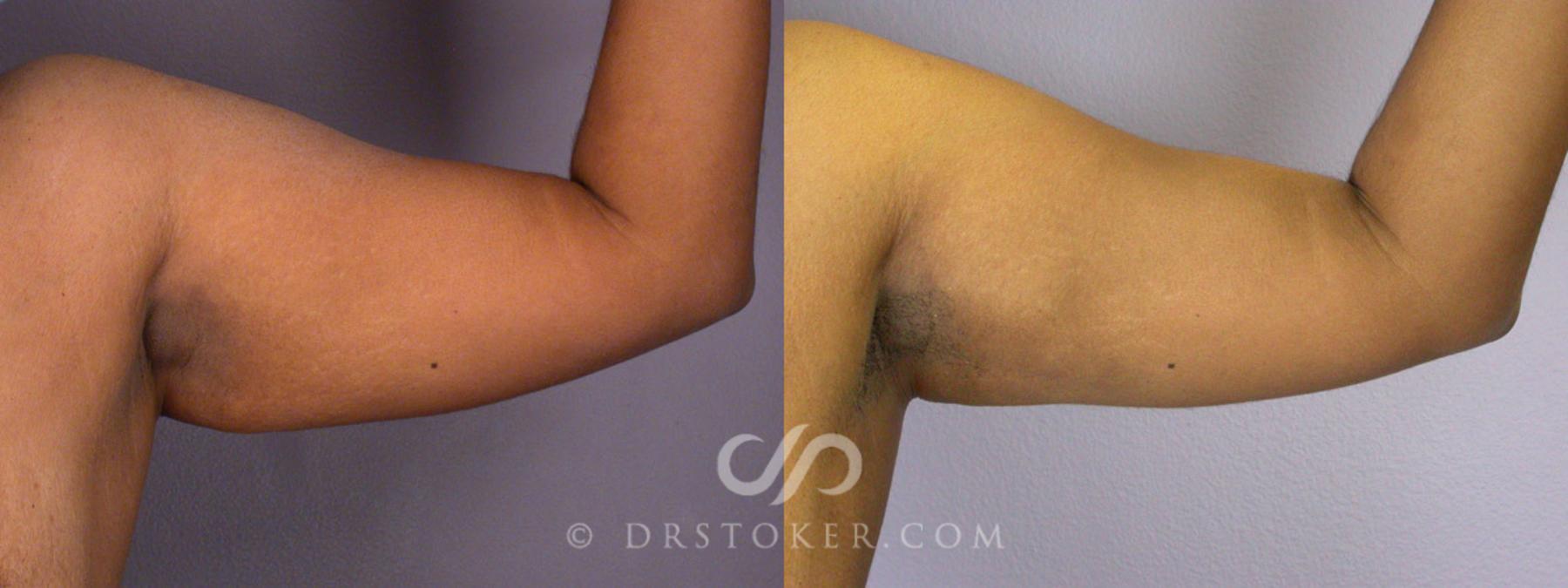 Before & After Tummy Tuck Case 239 View #17 View in Los Angeles, CA