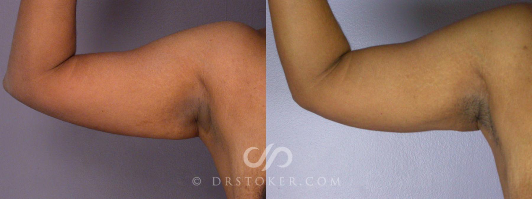 Before & After Tummy Tuck Case 239 View #18 View in Los Angeles, CA