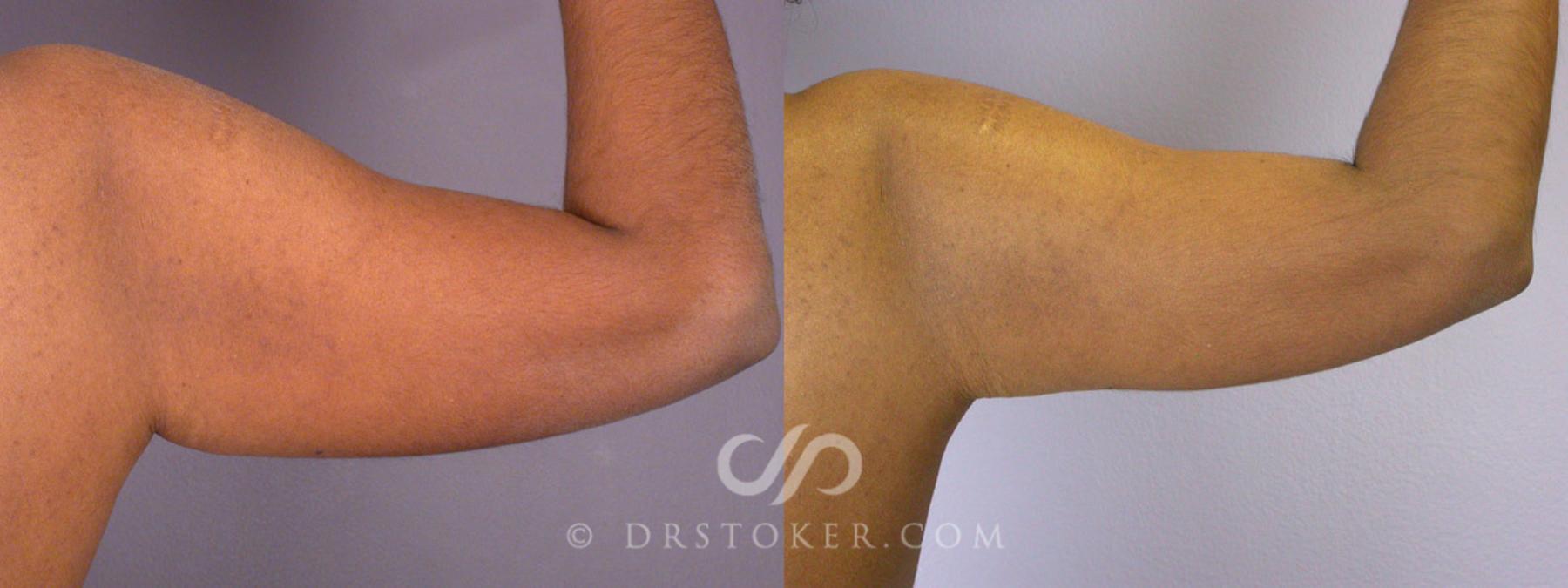 Before & After Breast Lift Case 239 View #19 View in Los Angeles, CA