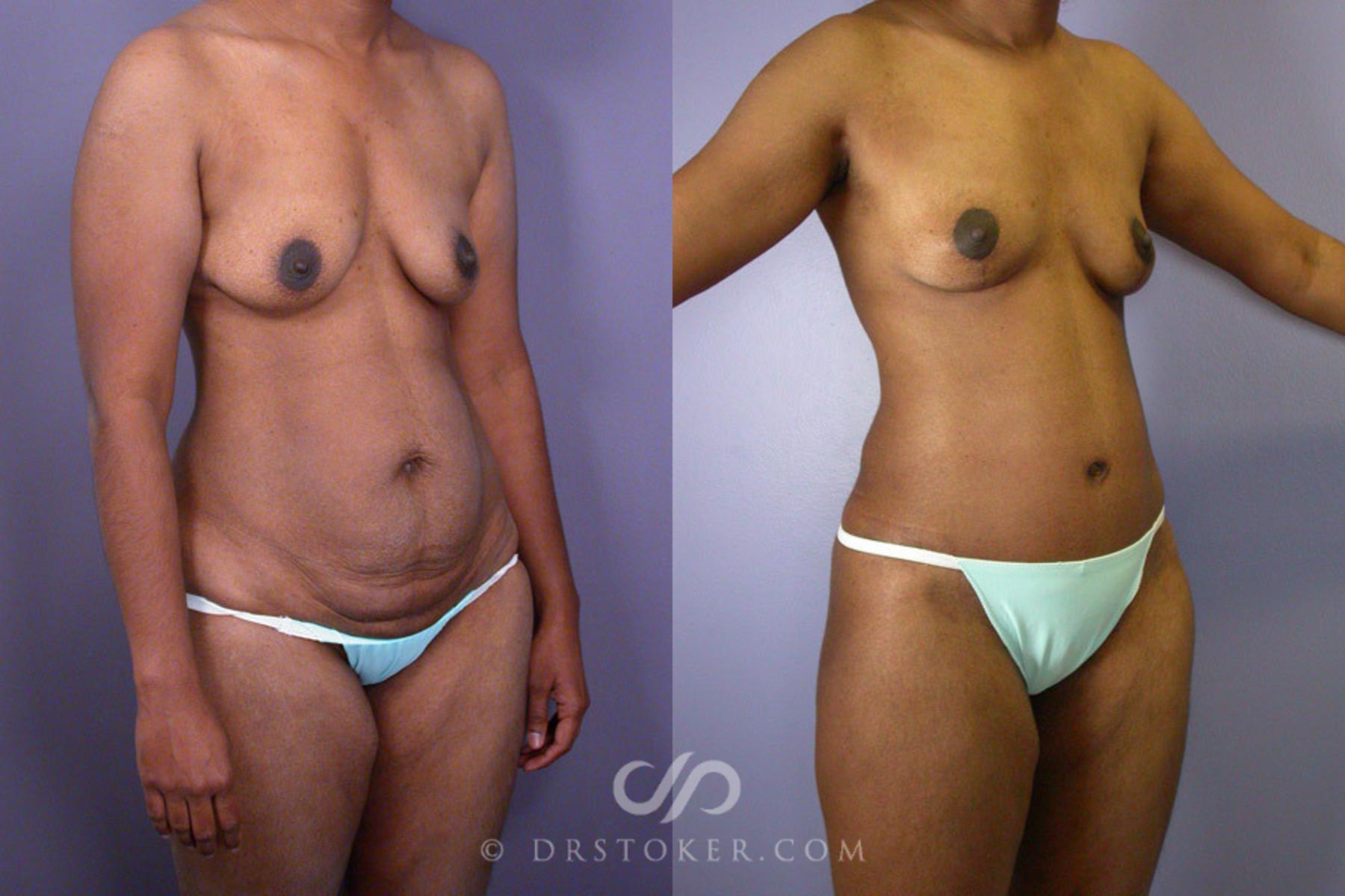Before & After Breast Lift Case 239 View #2 View in Los Angeles, CA