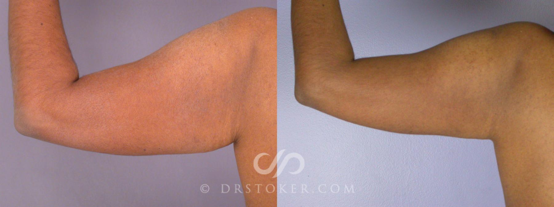 Before & After Tummy Tuck Case 239 View #20 View in Los Angeles, CA