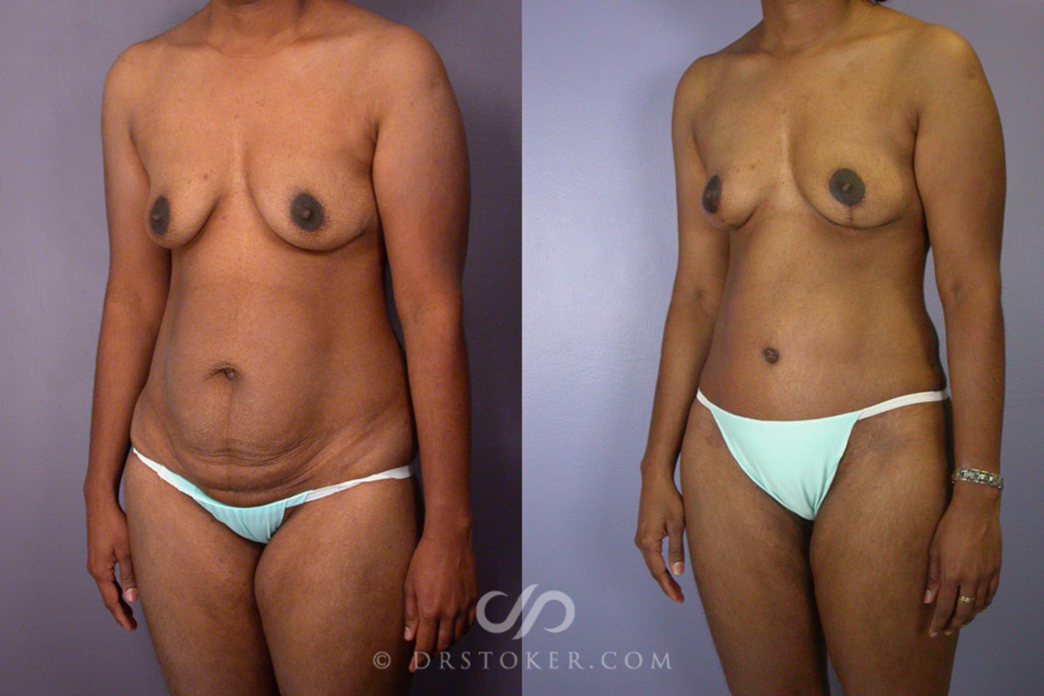 Before & After Tummy Tuck Case 239 View #3 View in Los Angeles, CA