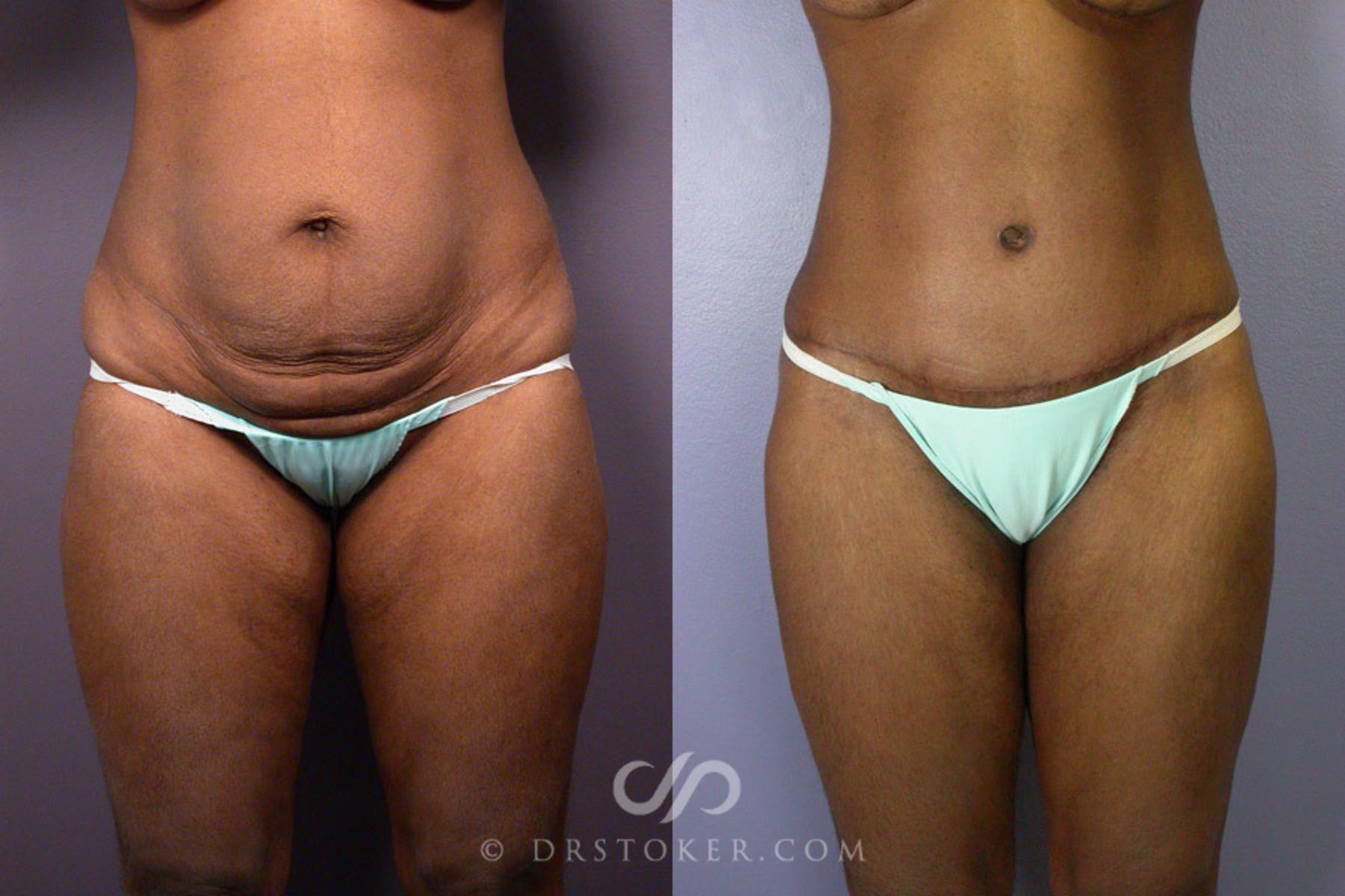 Before & After Tummy Tuck Case 239 View #4 View in Los Angeles, CA