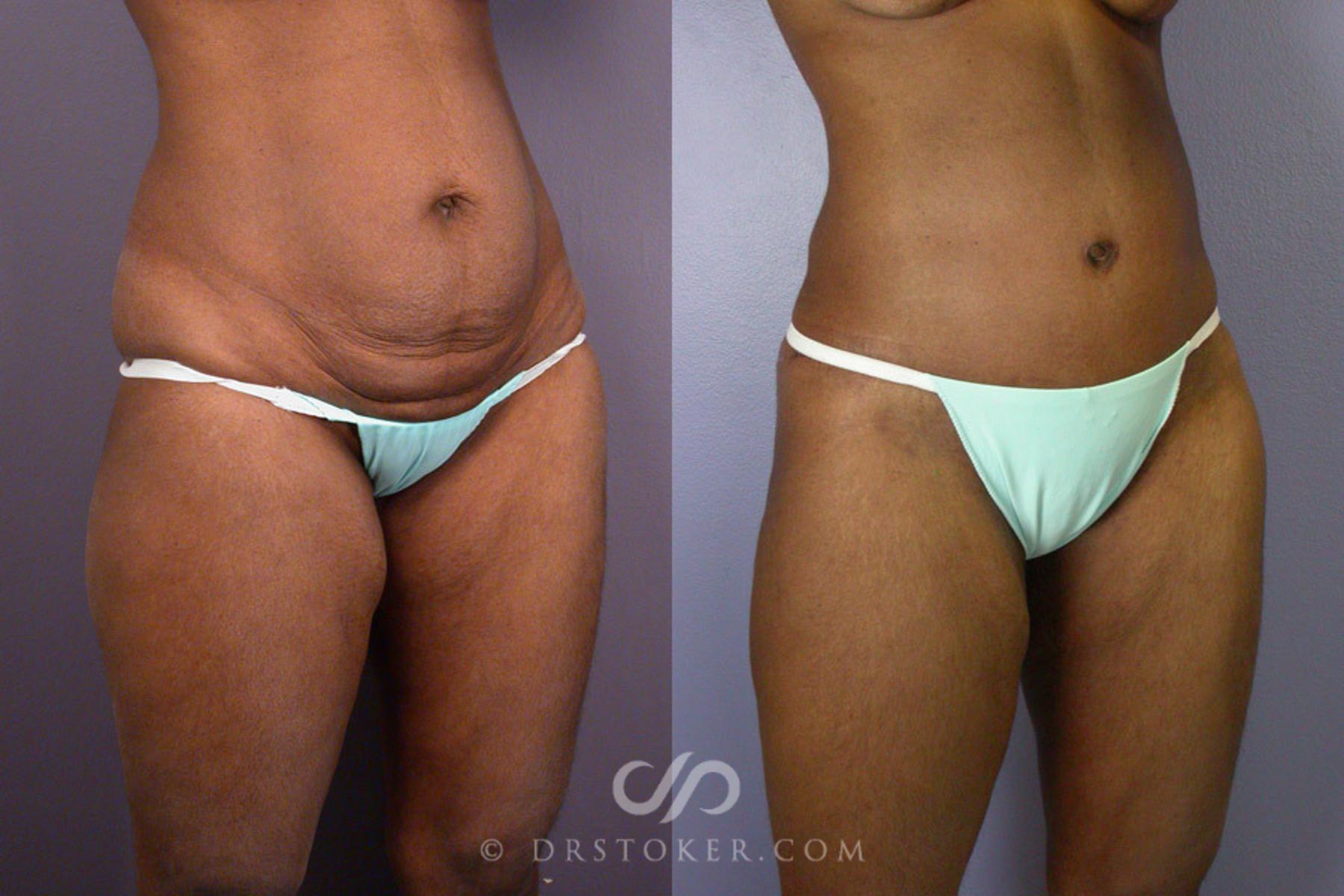 Before & After Tummy Tuck Case 239 View #5 View in Los Angeles, CA