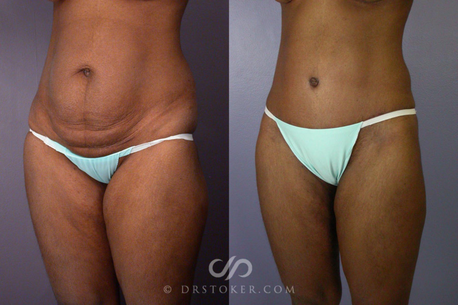 Before & After Tummy Tuck Case 239 View #6 View in Los Angeles, CA