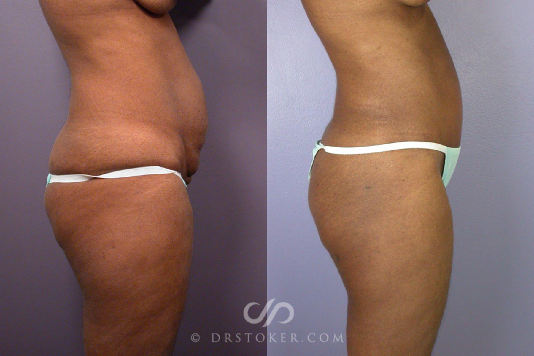 Before & After Tummy Tuck Case 239 View #7 View in Los Angeles, CA