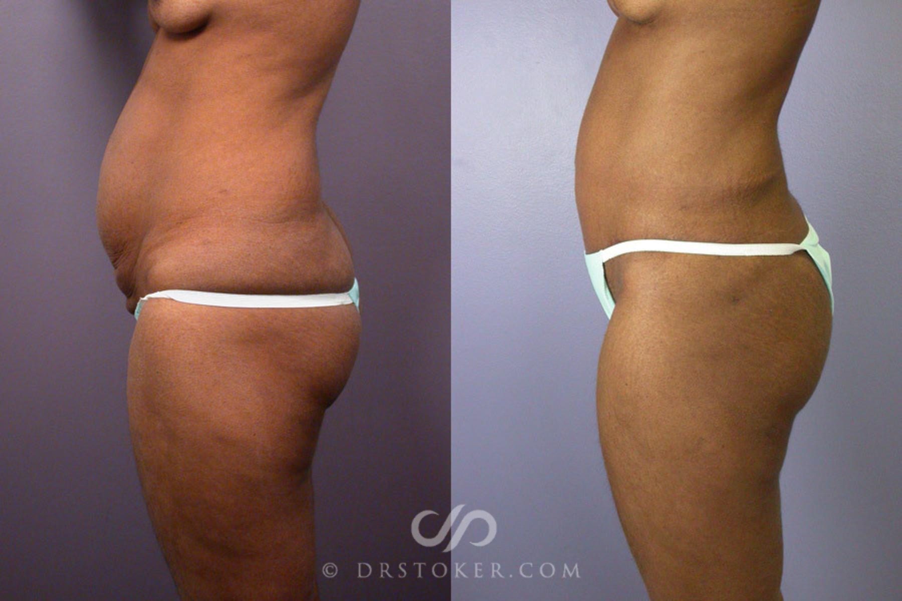 Before & After Breast Lift Case 239 View #8 View in Los Angeles, CA